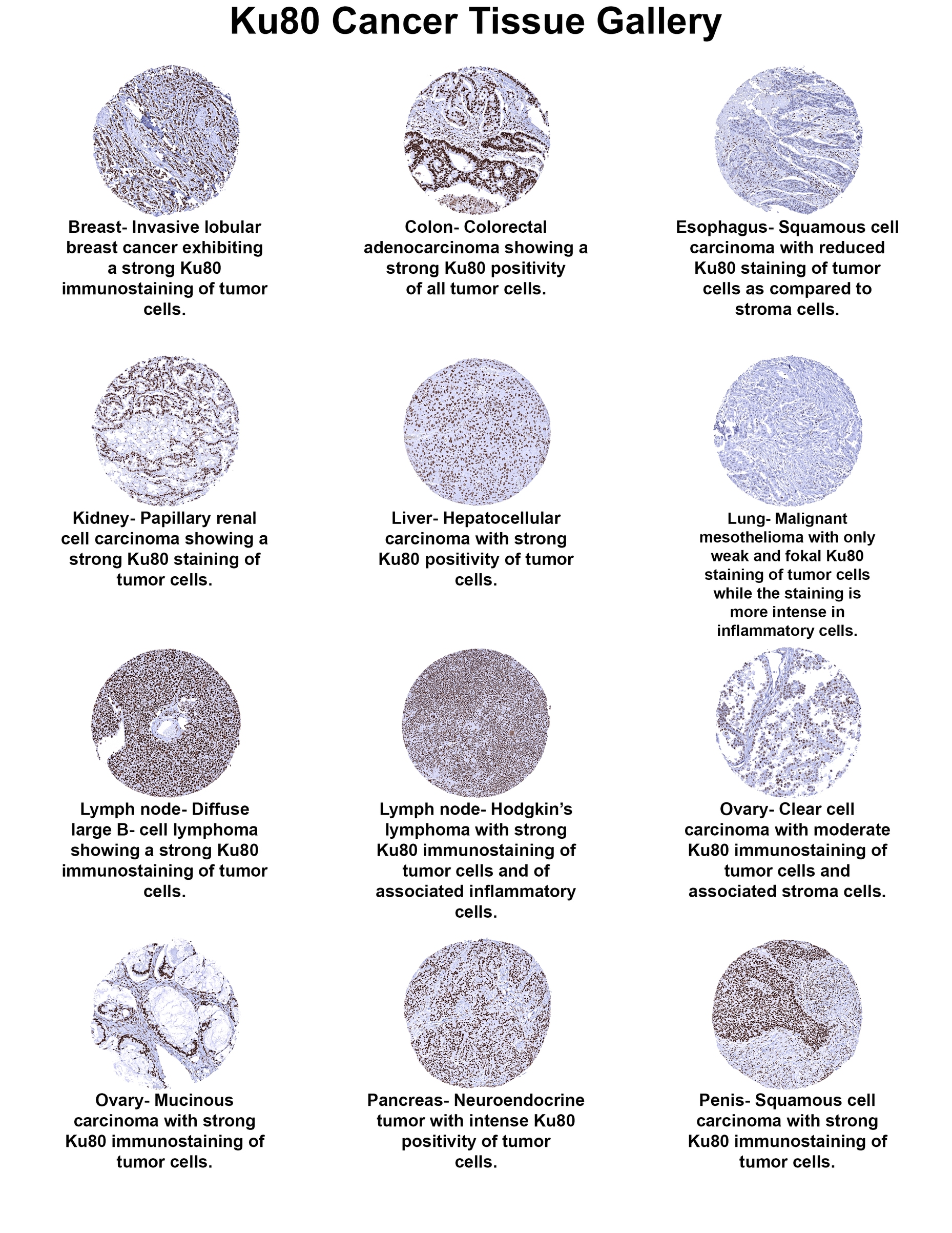 Ku80/XRCC5 Antibody (MSVA-880M) Ku80/XRCC5 Antibody (MSVA-880M) Ku80/XRCC5 Cancer Tissue Gallery