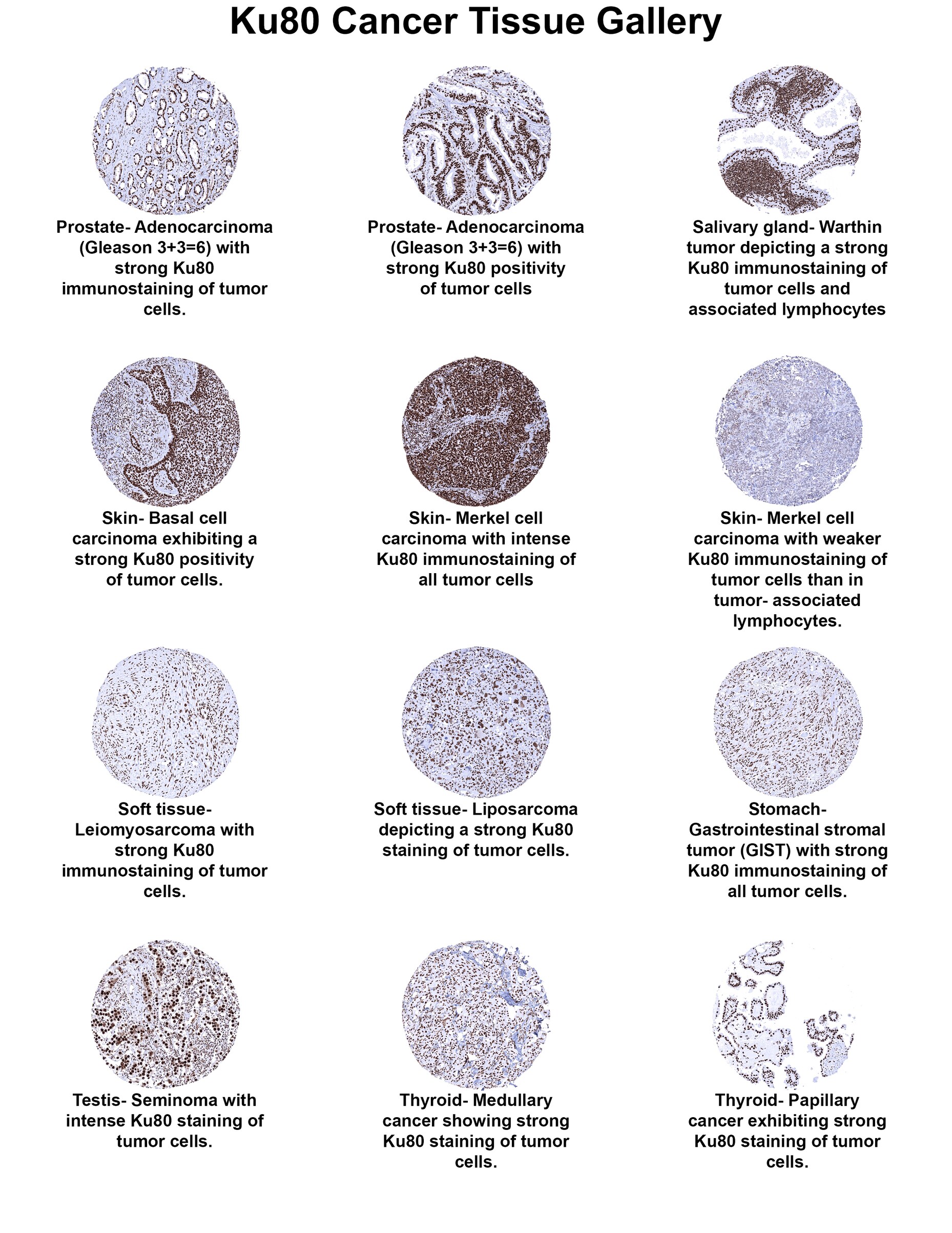 Ku80/XRCC5 Antibody (MSVA-880M) Ku80/XRCC5 Antibody (MSVA-880M) Ku80/XRCC5 Cancer Tissue Gallery