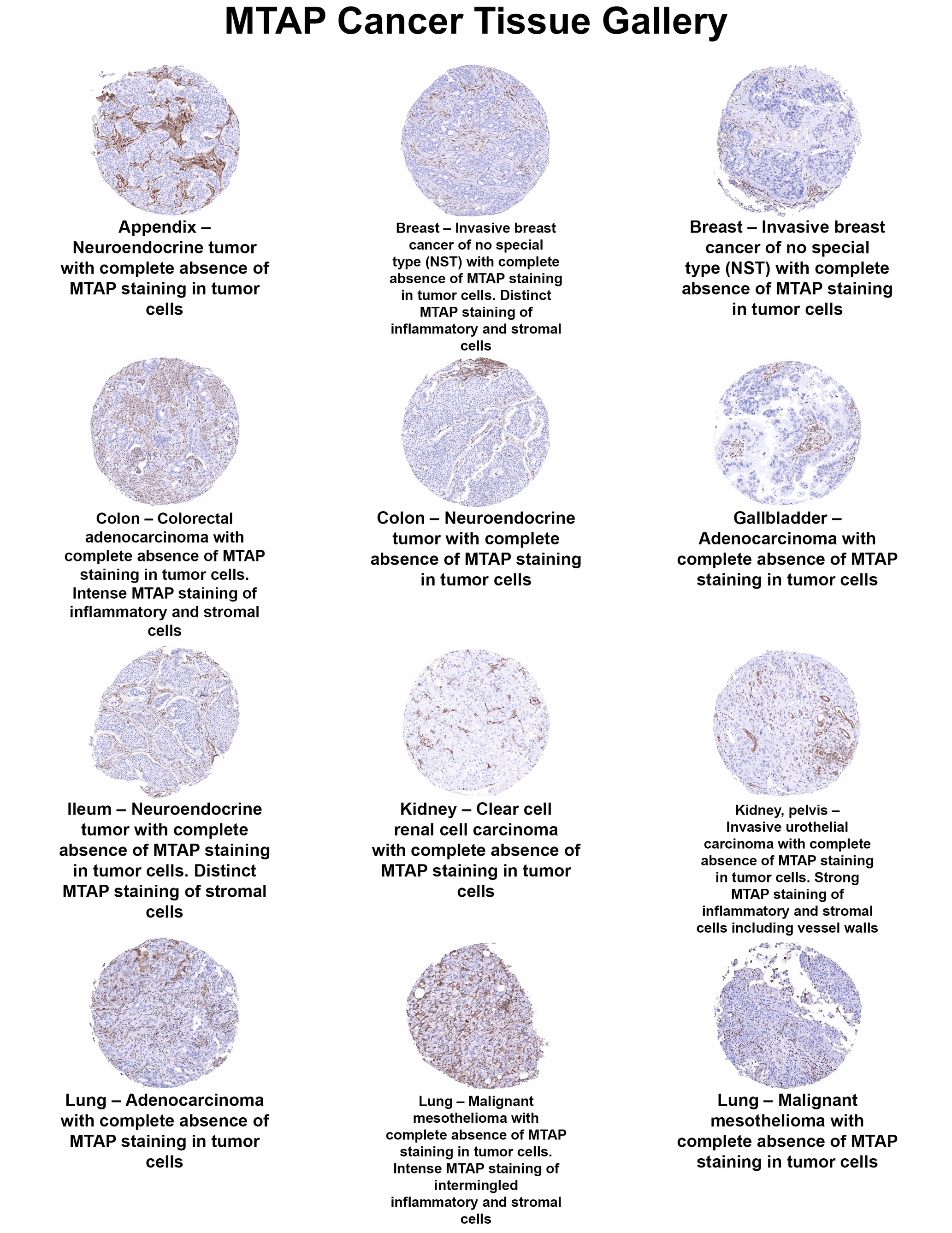 MTAP Antibody (MSVA-741R) MTAP Antibody (MSVA-741R) MTAP Cancer Tissue Gallery