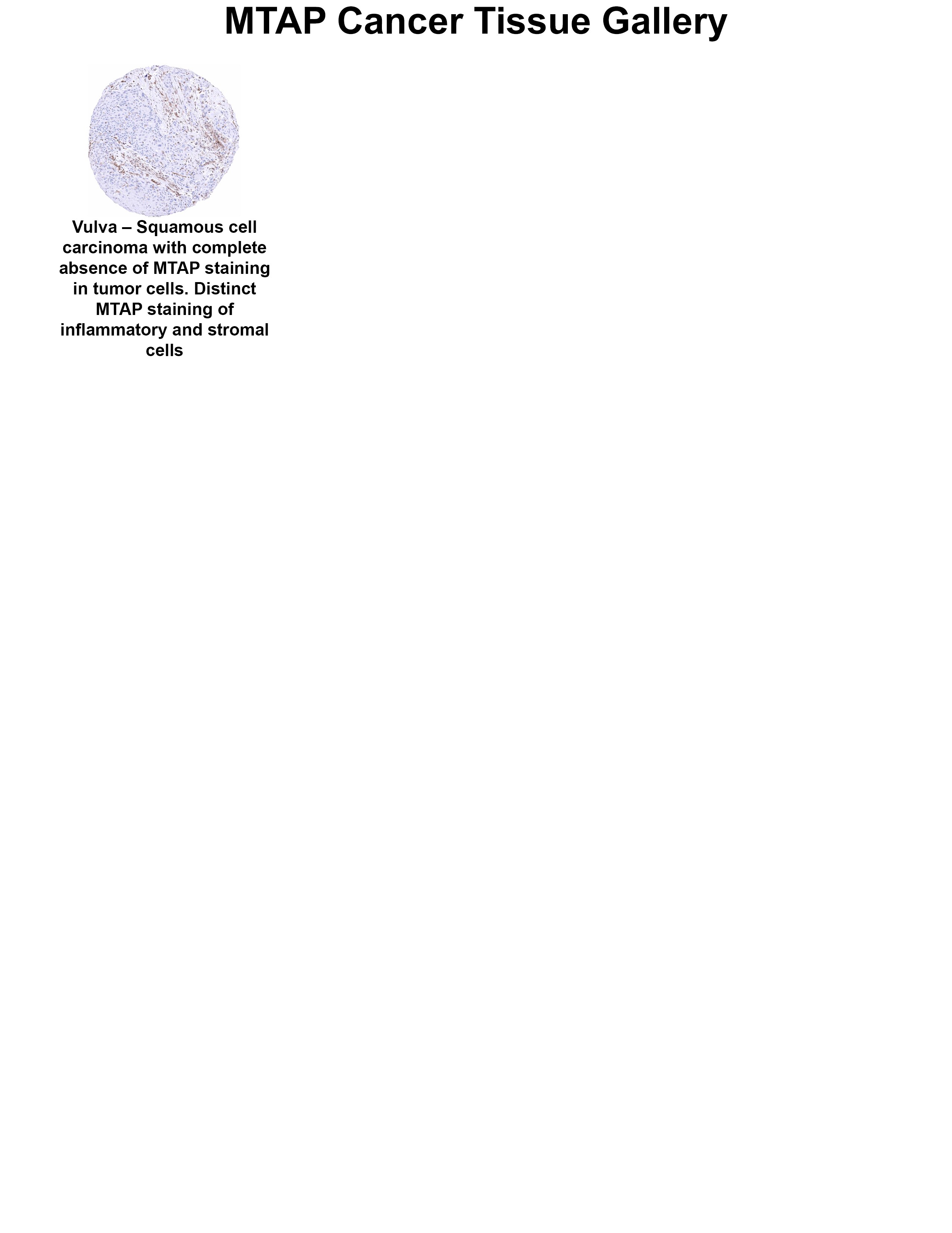 MTAP Antibody (MSVA-741R) MTAP Antibody (MSVA-741R) MTAP Cancer Tissue Gallery