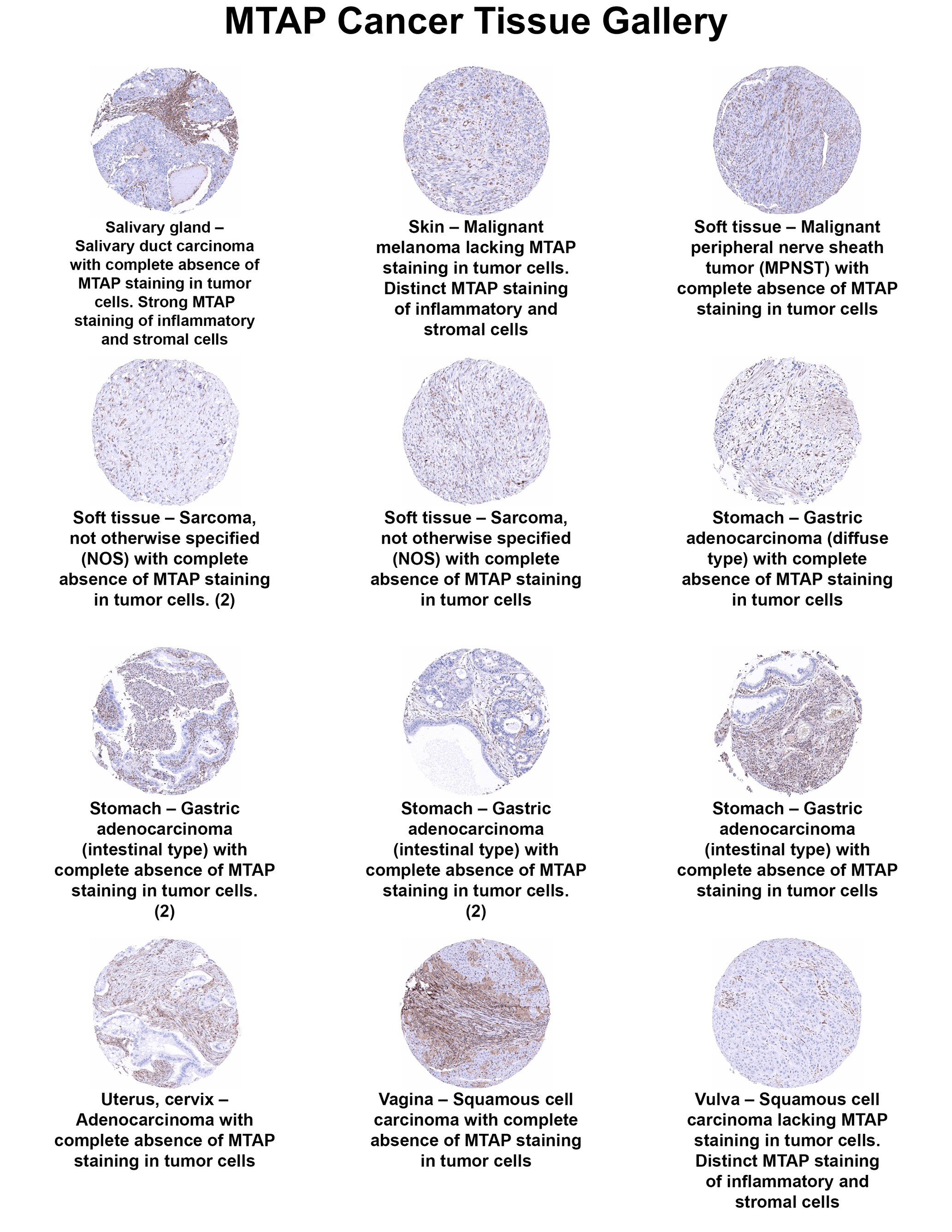 MTAP Antibody (MSVA-741R) MTAP Antibody (MSVA-741R) MTAP Cancer Tissue Gallery