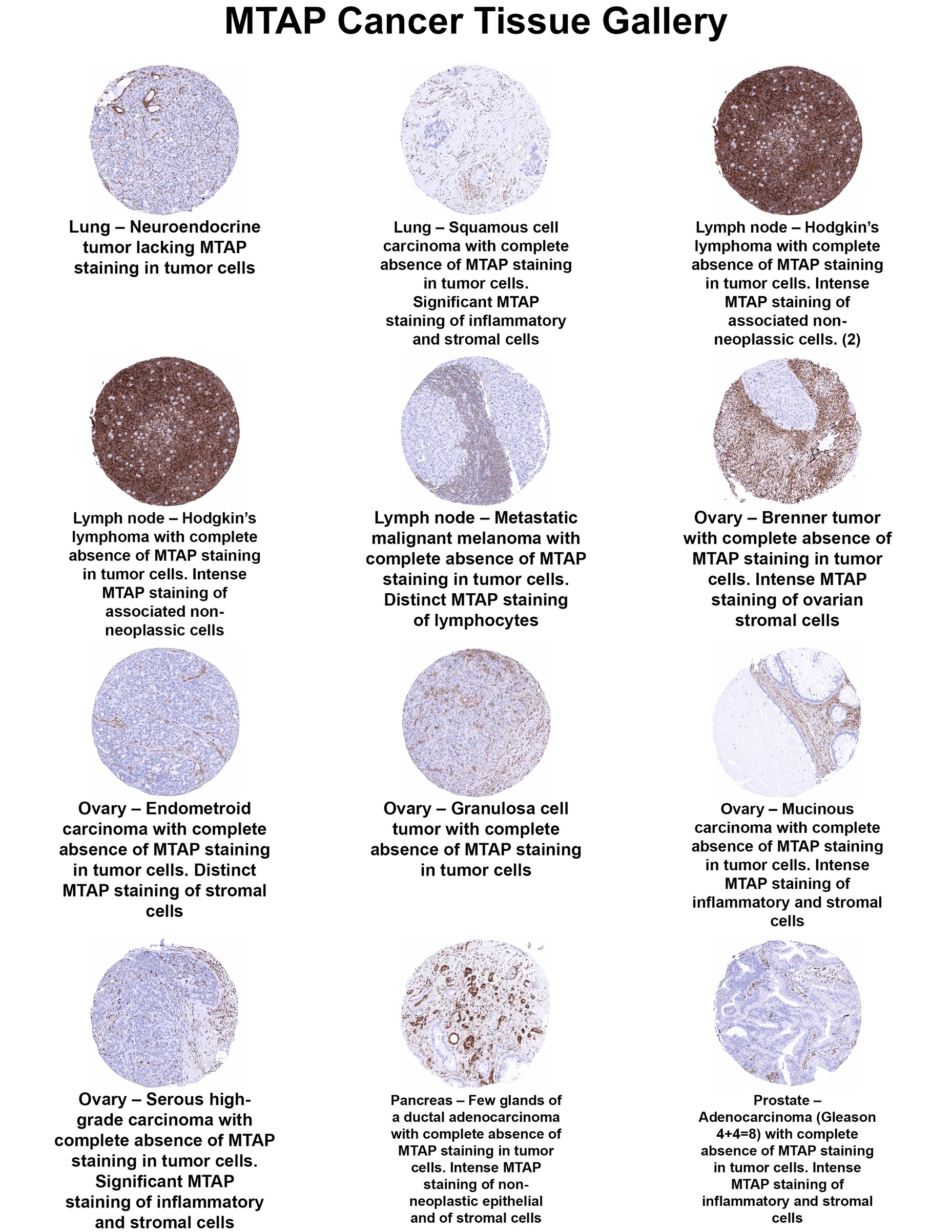 MTAP Antibody (MSVA-741R) MTAP Antibody (MSVA-741R) MTAP Cancer Tissue Gallery
