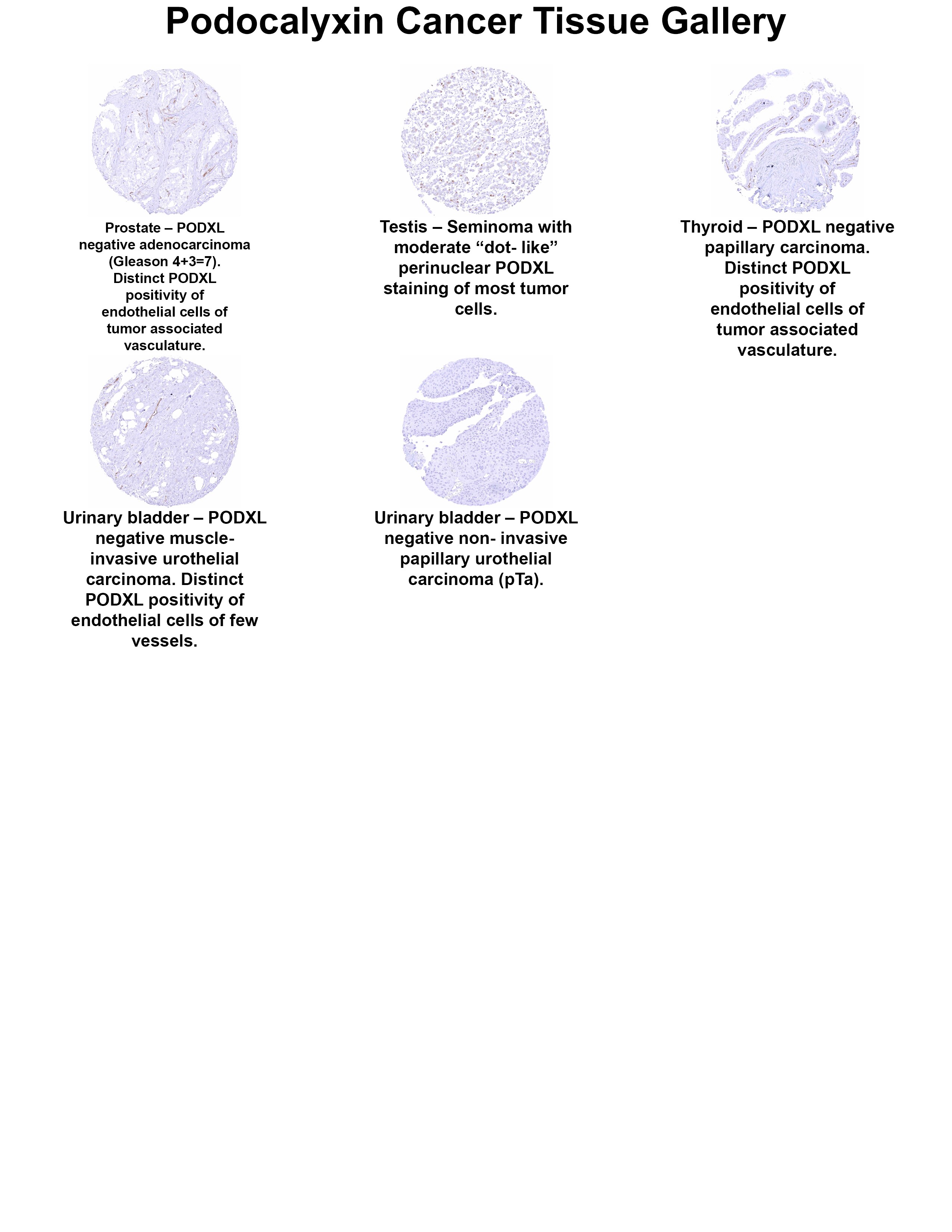 Podocalyxin Like Antibody (MSVA-645M) Podocalyxin Like Antibody (MSVA-645M) Podocalyxin Like Cancer Tissue Gallery