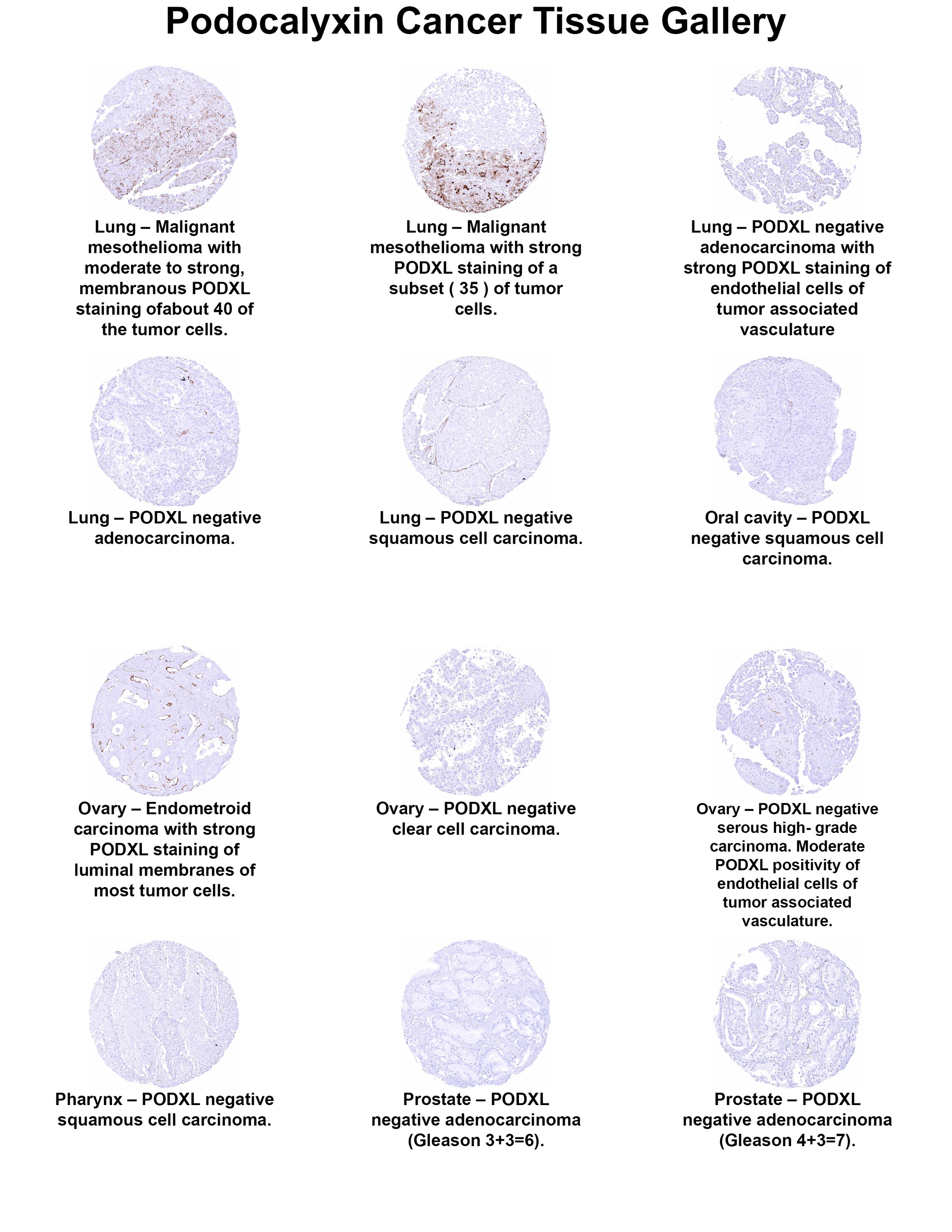 Podocalyxin Like Antibody (MSVA-645M) Podocalyxin Like Antibody (MSVA-645M) Podocalyxin Like Cancer Tissue Gallery