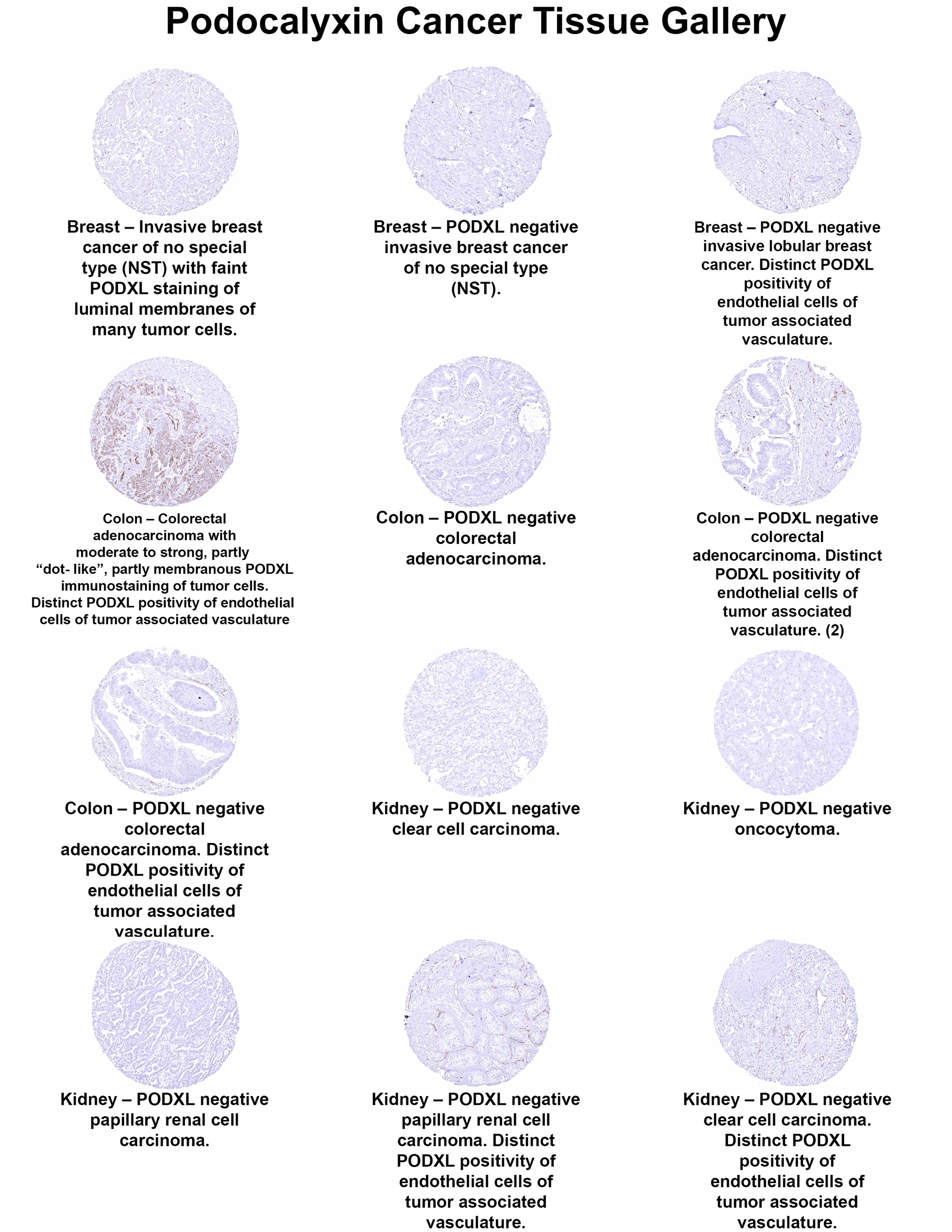 Podocalyxin Like Antibody (MSVA-645M) Podocalyxin Like Antibody (MSVA-645M) Podocalyxin Like Cancer Tissue Gallery