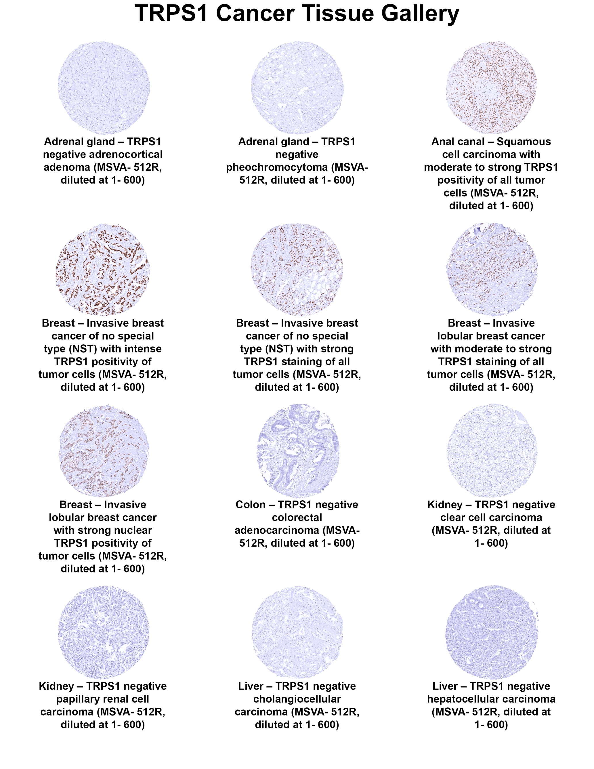 TRPS1 Antibody (MSVA-512R) TRPS1 Antibody (MSVA-512R) TRPS1 Cancer Tissue Gallery