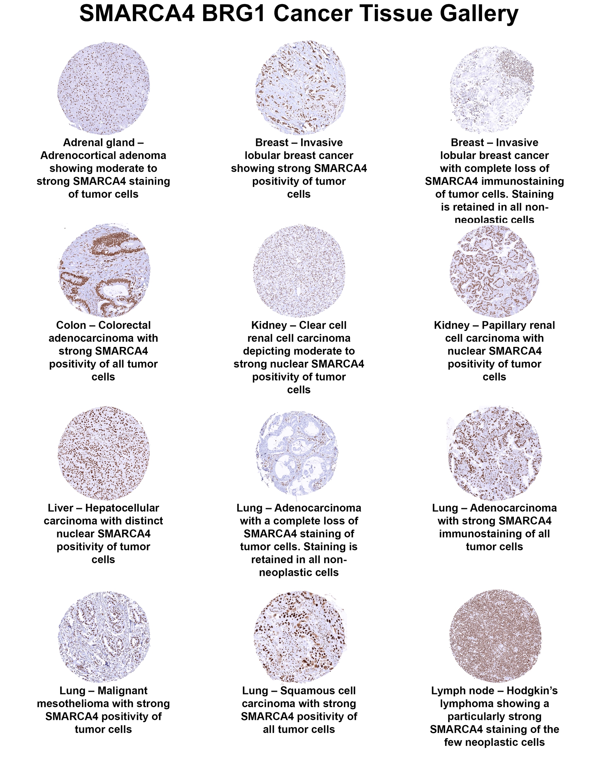 Brg1 Antibody (MSVA-397R) Brg1 Antibody (MSVA-397R) Brg1 Cancer Tissue Gallery