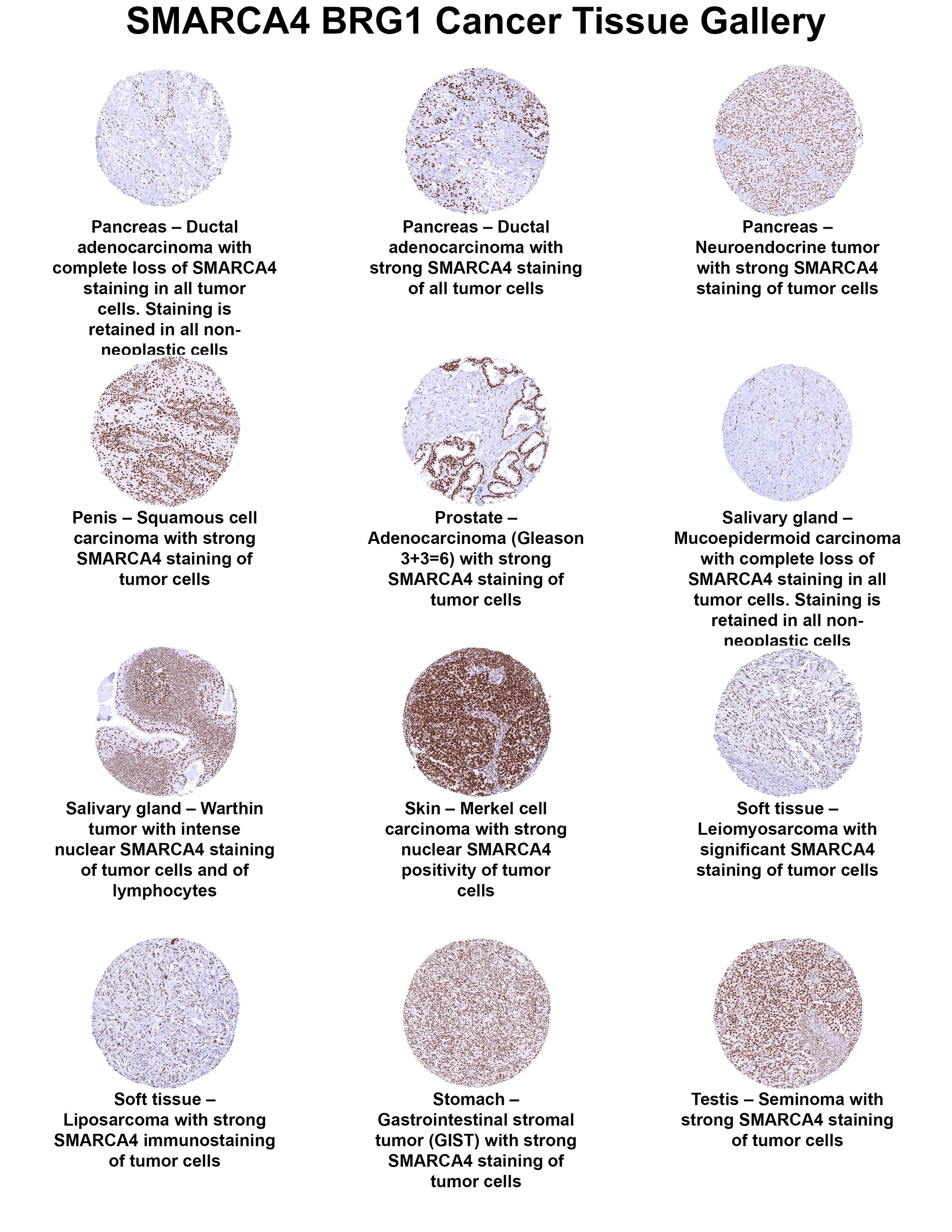 Brg1 Antibody (MSVA-397R) Brg1 Antibody (MSVA-397R) Brg1 Cancer Tissue Gallery