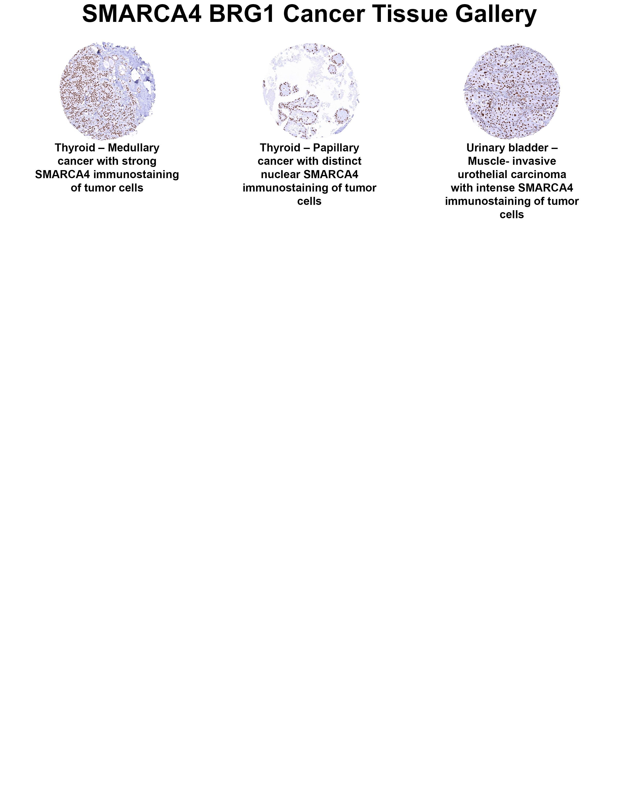 Brg1 Antibody (MSVA-397R) Brg1 Antibody (MSVA-397R) Brg1 Cancer Tissue Gallery