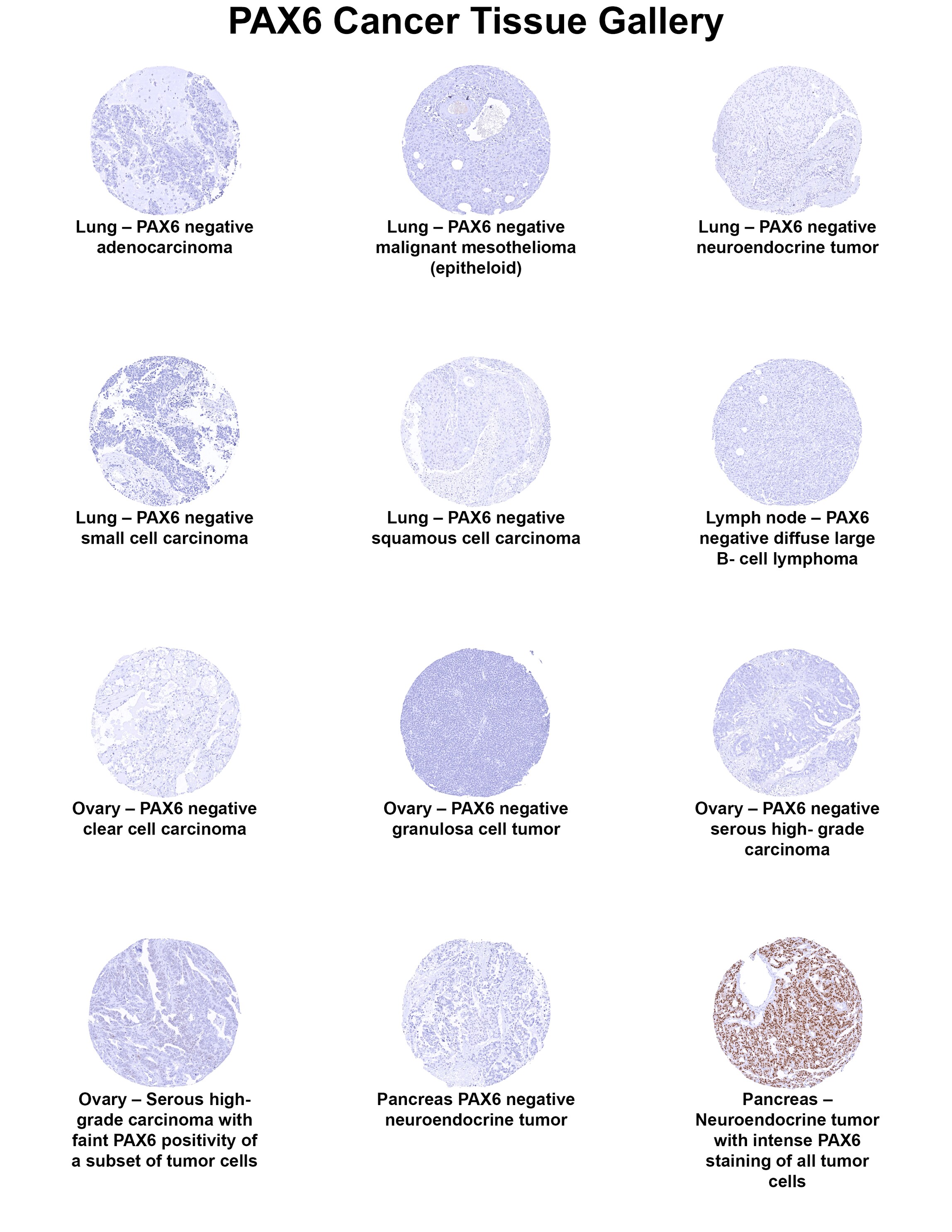 Pax6 Antibody (MSVA-706M) Pax6 Antibody (MSVA-706M) Pax6 Cancer Tissue Gallery