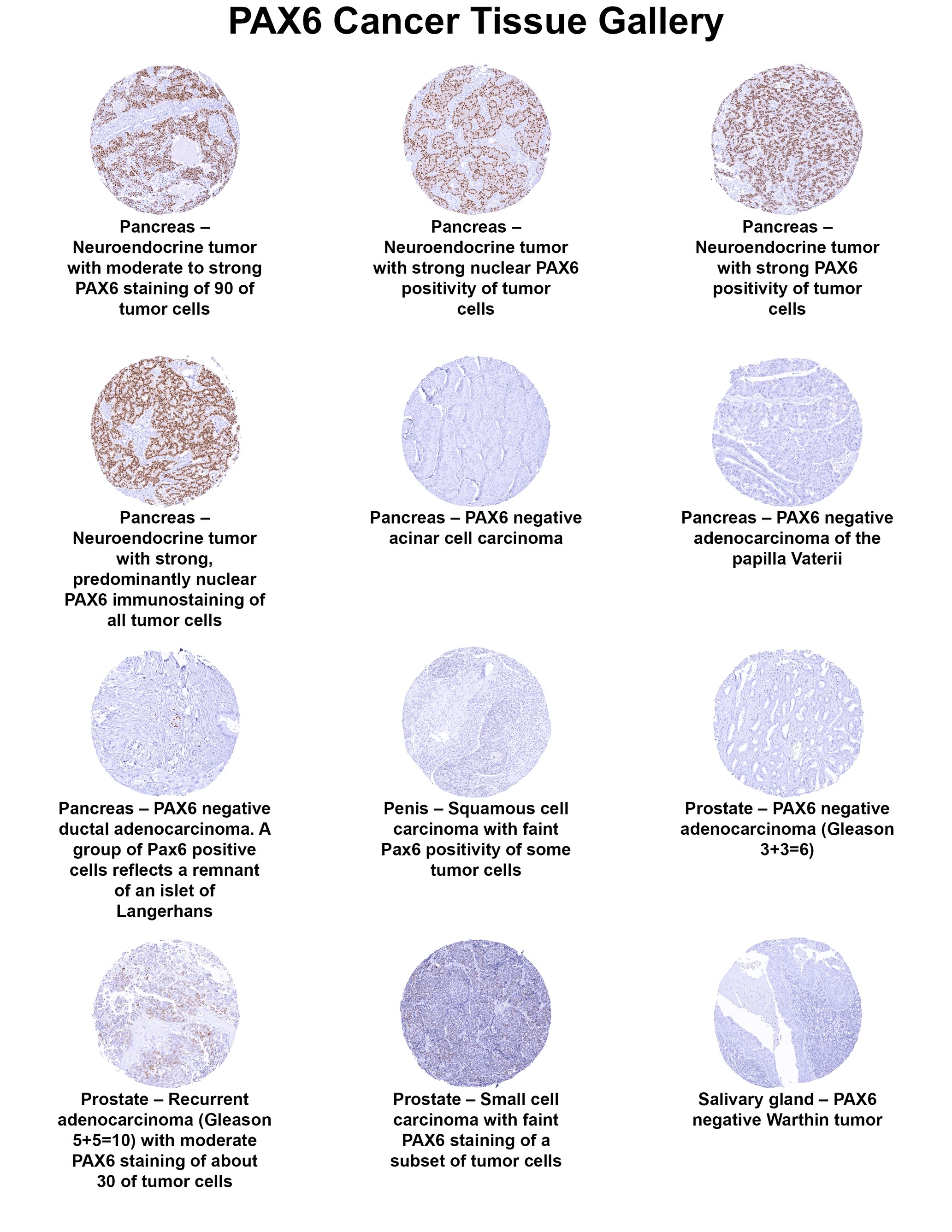 Pax6 Antibody (MSVA-706M) Pax6 Antibody (MSVA-706M) Pax6 Cancer Tissue Gallery