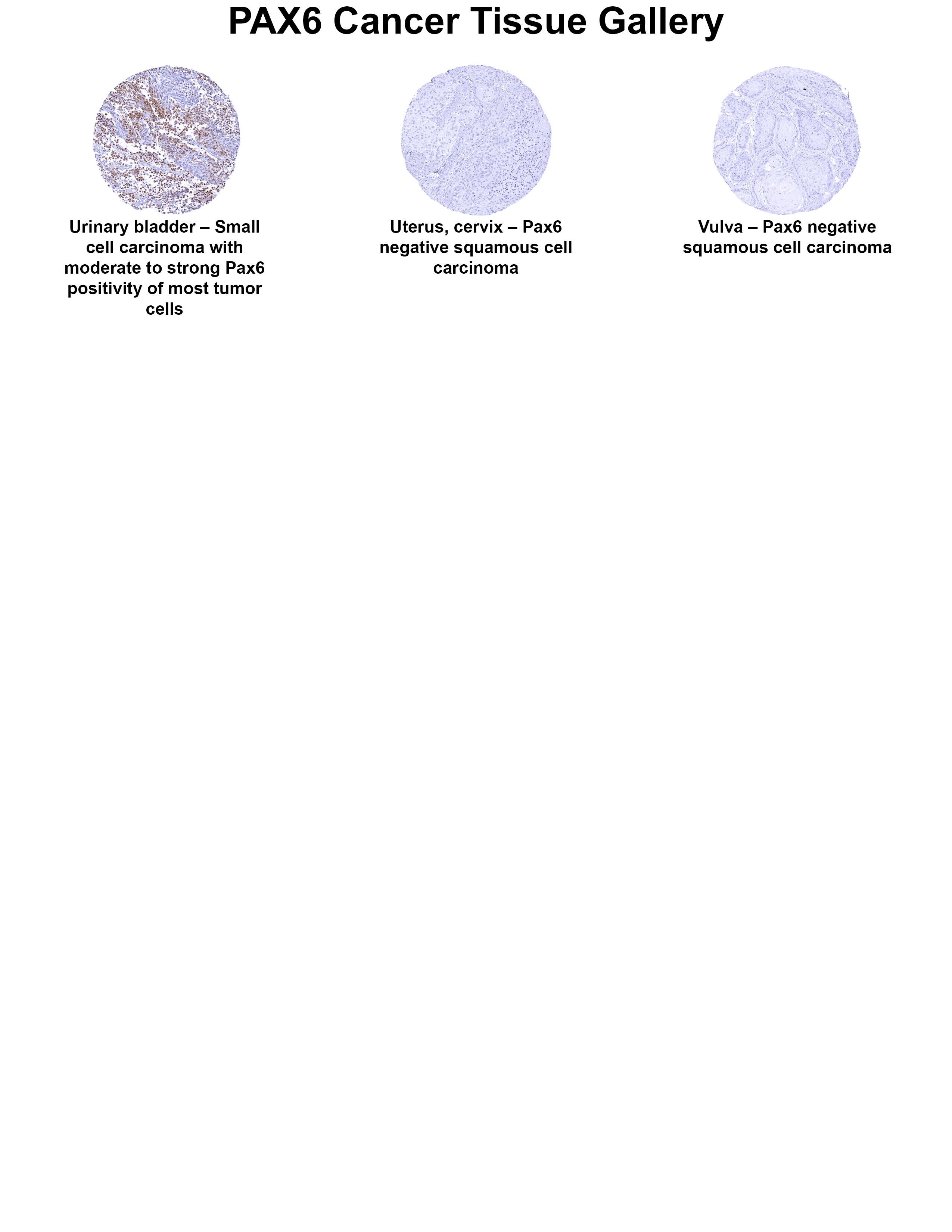 Pax6 Antibody (MSVA-706M) Pax6 Antibody (MSVA-706M) Pax6 Cancer Tissue Gallery