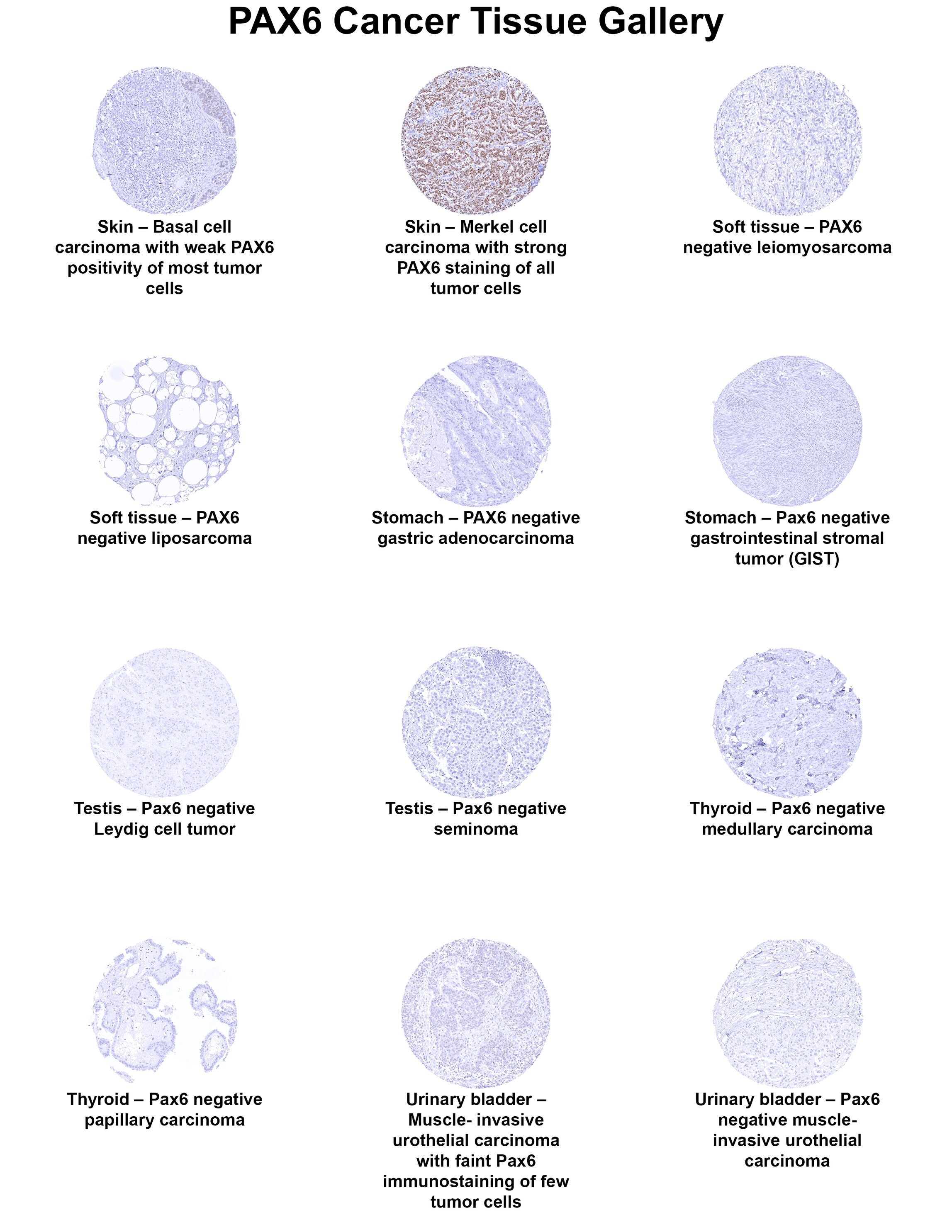 Pax6 Antibody (MSVA-706M) Pax6 Antibody (MSVA-706M) Pax6 Cancer Tissue Gallery