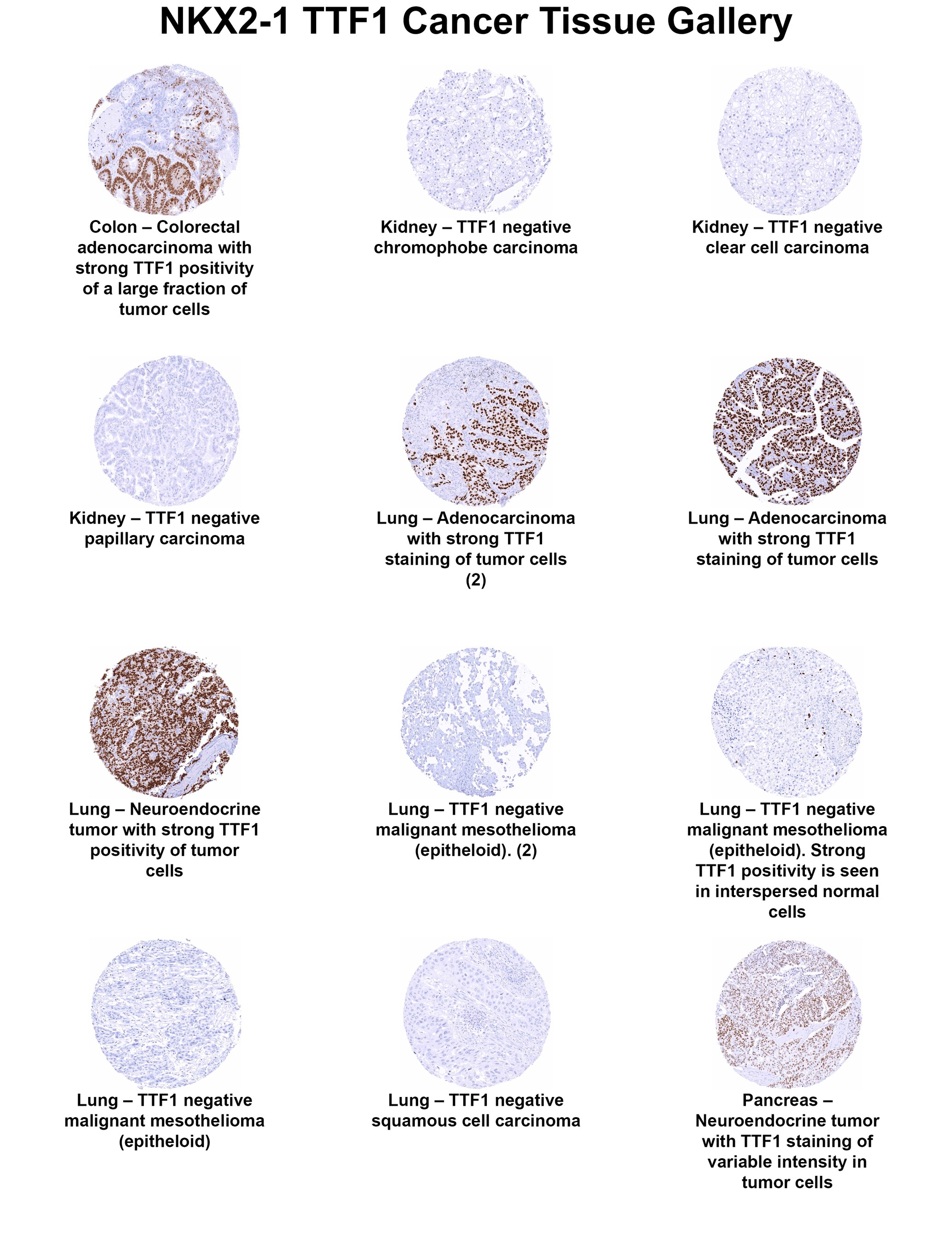 TTF-1 / NKX2-1 Antibody (MSVA-312R) TTF-1 / NKX2-1 Antibody (MSVA-312R) TTF-1 / NKX2-1 Cancer Tissue Gallery