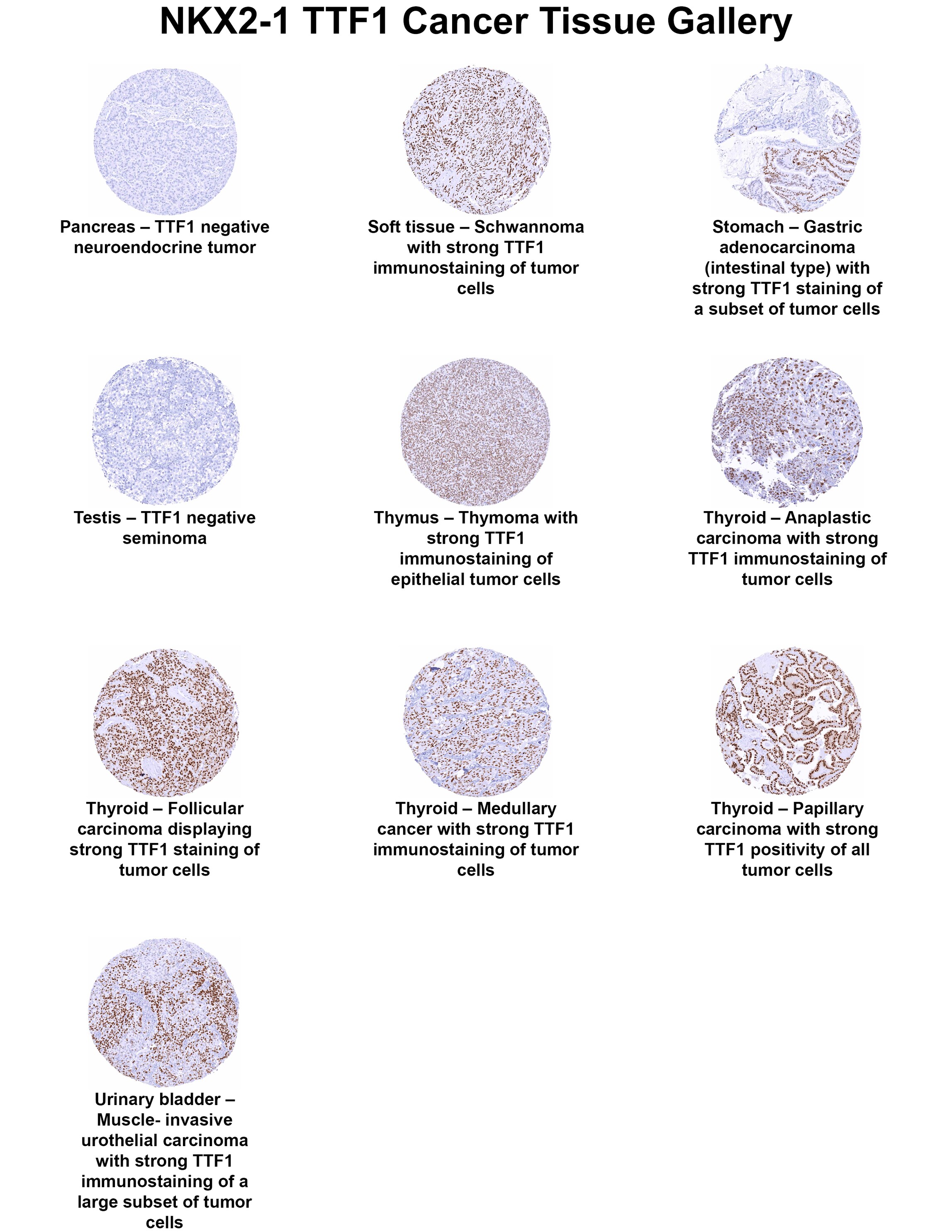 TTF-1 / NKX2-1 Antibody (MSVA-312R) TTF-1 / NKX2-1 Antibody (MSVA-312R) TTF-1 / NKX2-1 Cancer Tissue Gallery
