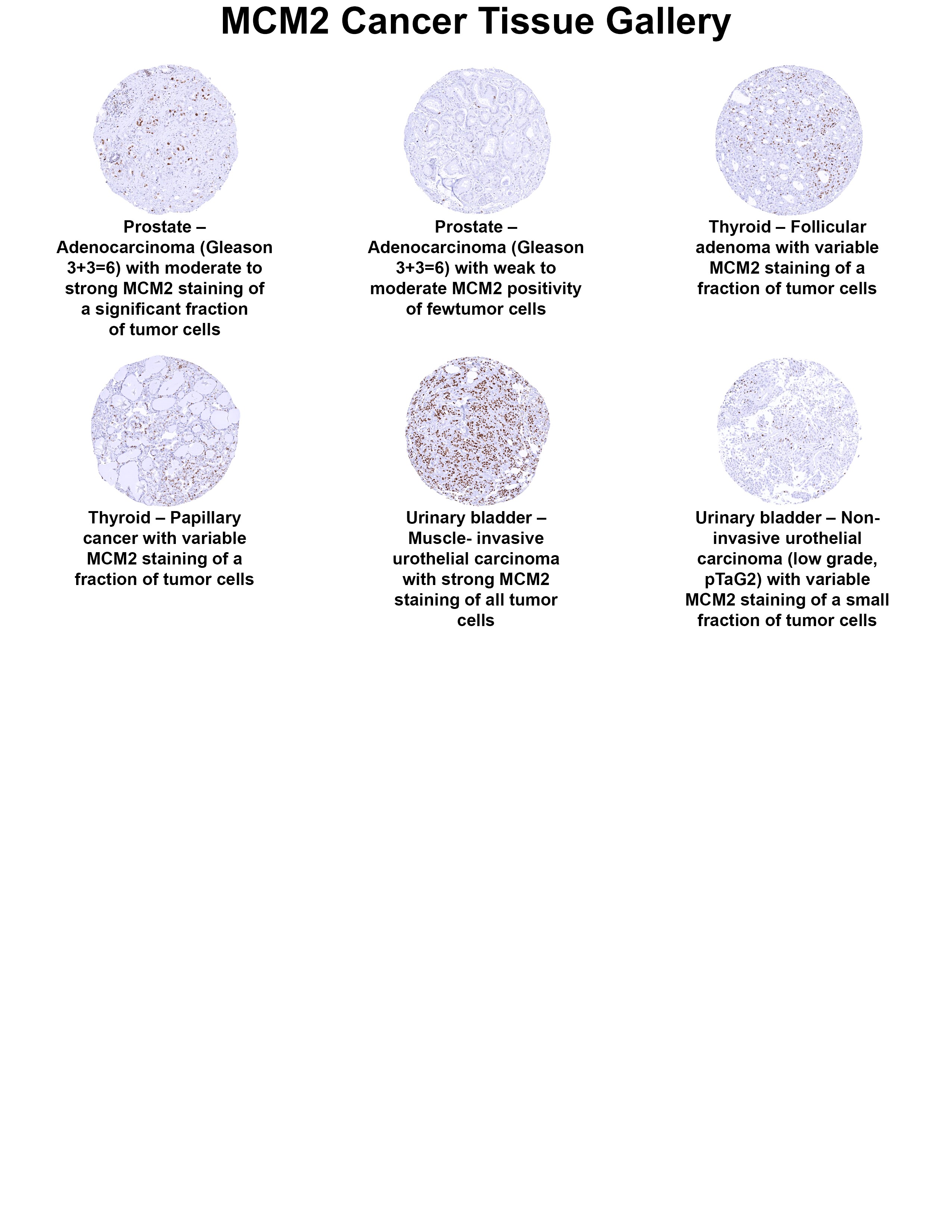 MCM2 Antibody (MSVA-502R) MCM2 Antibody (MSVA-502R) MCM2 Cancer Tissue Gallery