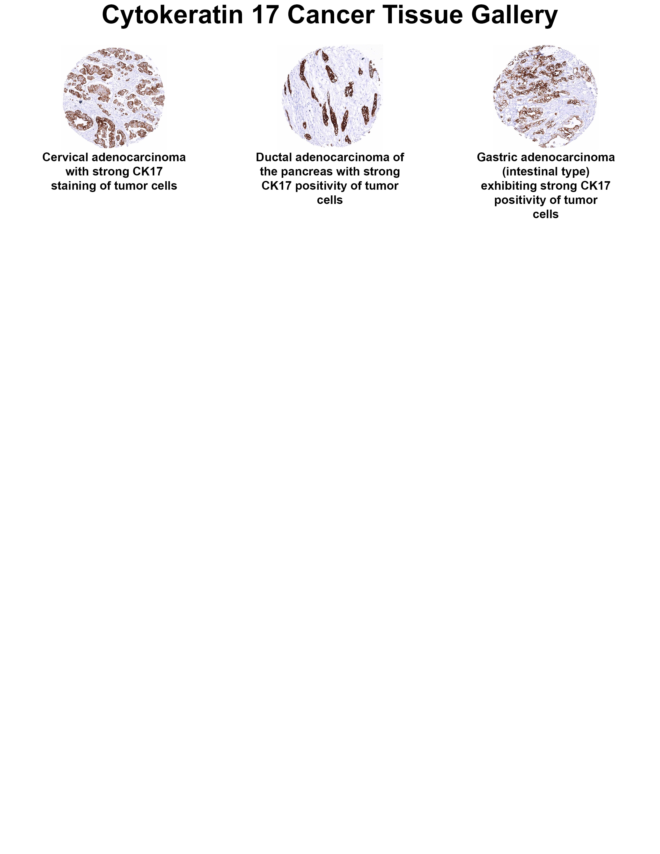 Cytokeratin 17 Antibody (MSVA-117R) Cytokeratin 17 Antibody (MSVA-117R) Cytokeratin 17 Cancer Tissue Gallery