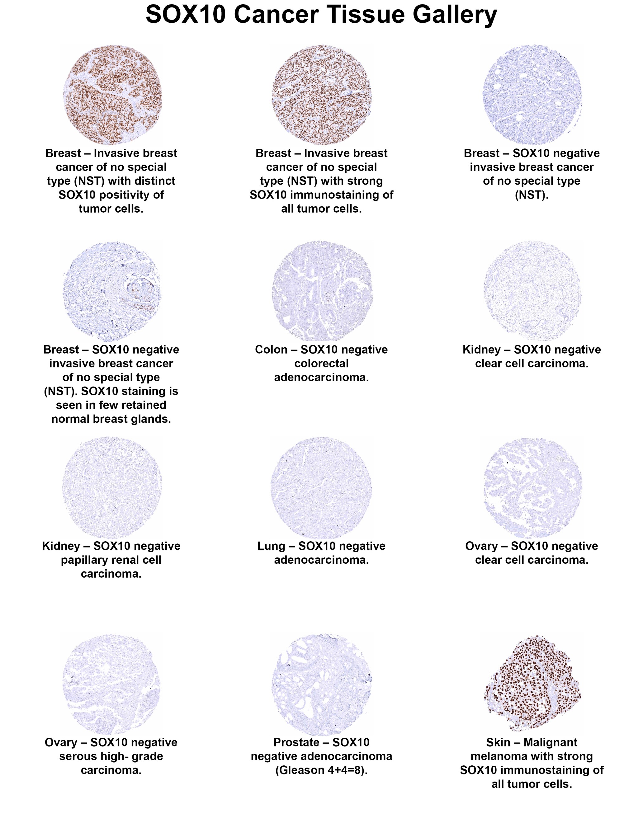 SOX10 Antibody (MSVA-710R) SOX10 Antibody (MSVA-710R) SOX10 Cancer Tissue Gallery