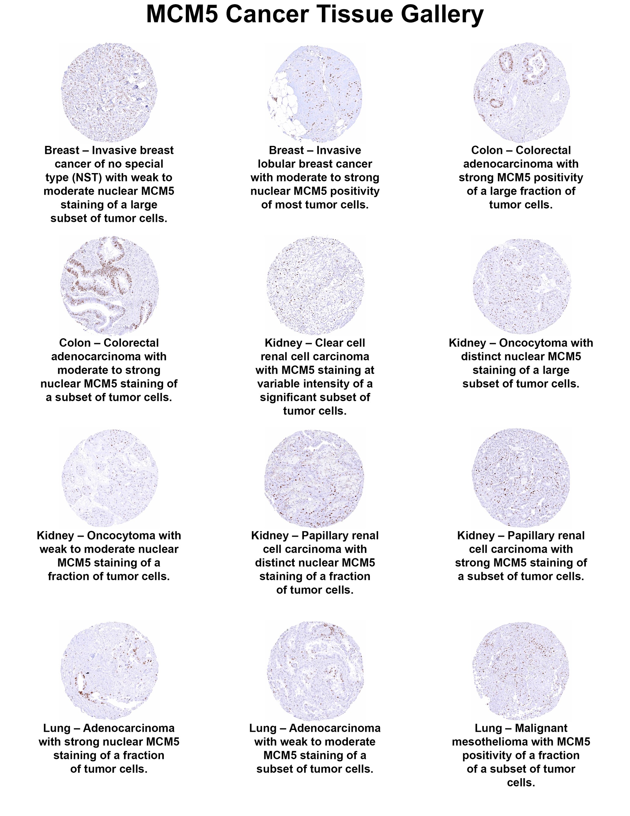 MCM5 Antibody (MSVA-505R) MCM5 Antibody (MSVA-505R) MCM5 Cancer Tissue Gallery
