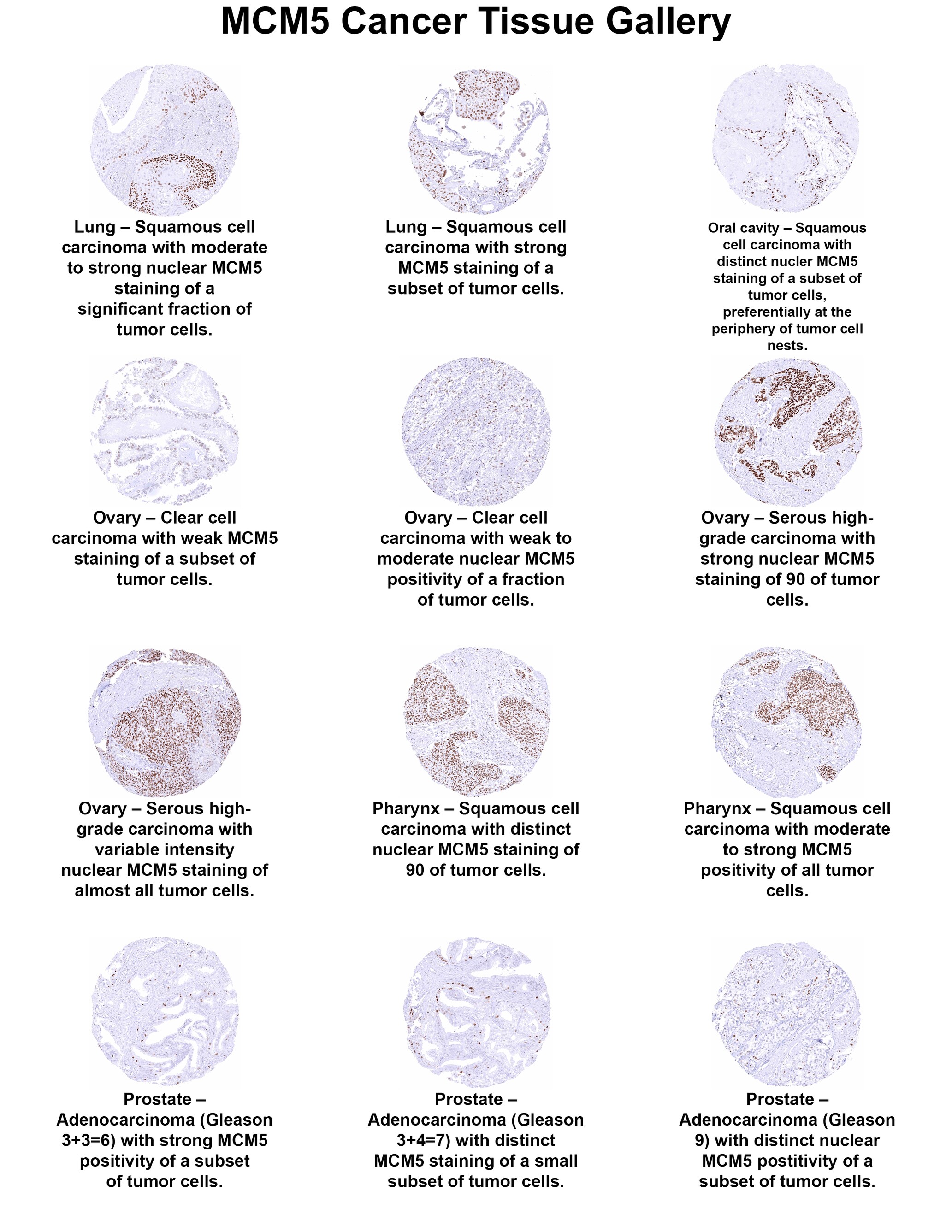 MCM5 Antibody (MSVA-505R) MCM5 Antibody (MSVA-505R) MCM5 Cancer Tissue Gallery