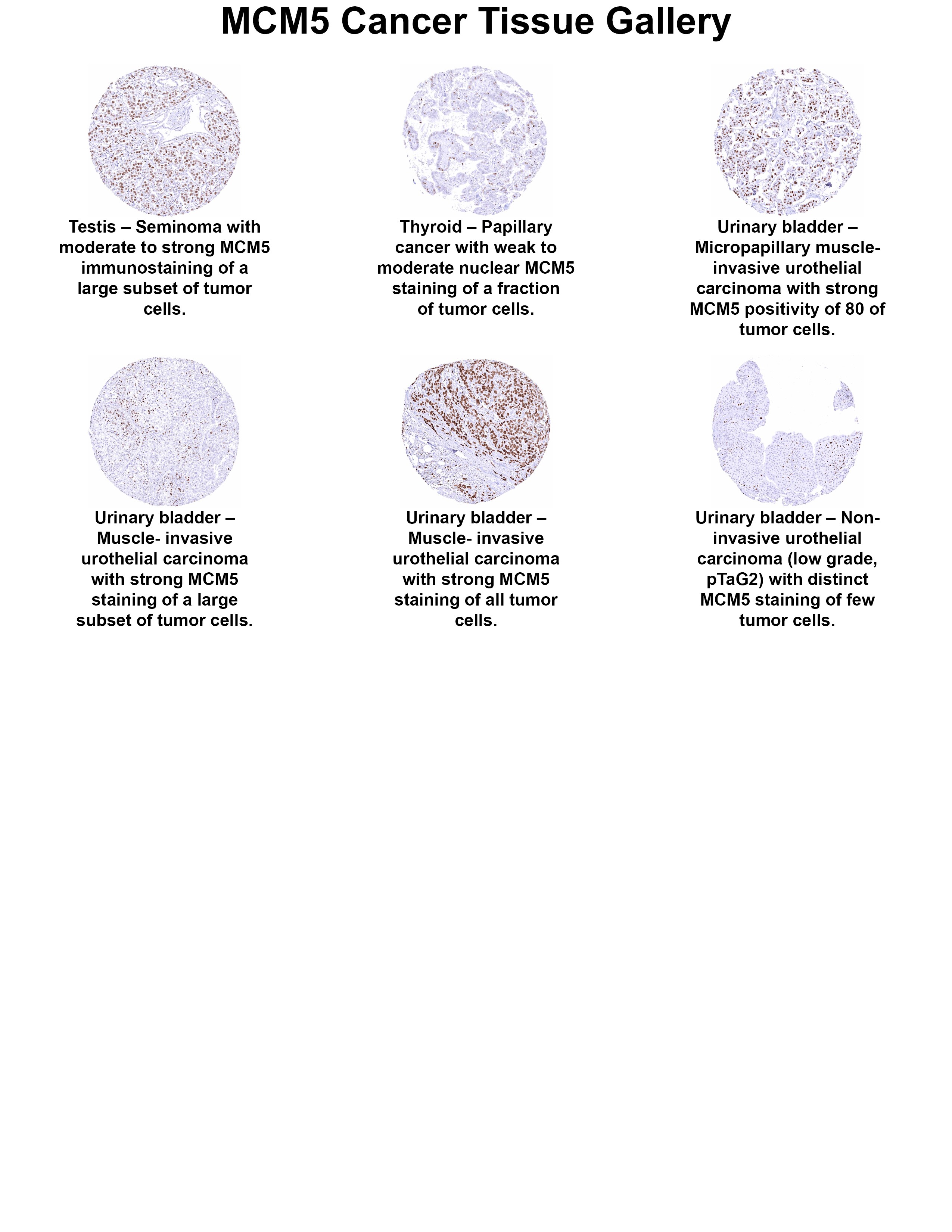 MCM5 Antibody (MSVA-505R) MCM5 Antibody (MSVA-505R) MCM5 Cancer Tissue Gallery