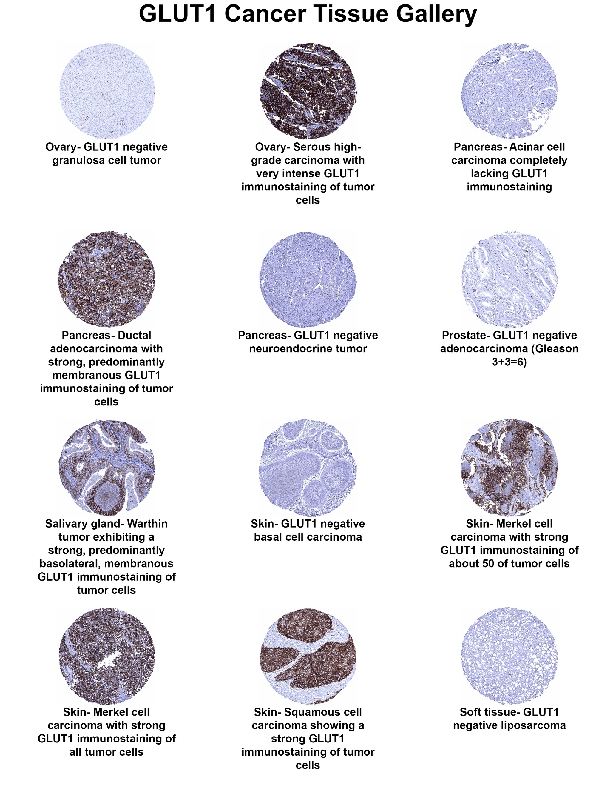 Glut1 Antibody (MSVA-401R) - Azide and BSA Free Glut1 Antibody (MSVA-401R) - Azide and BSA Free Glut1 Cancer Tissue Gallery