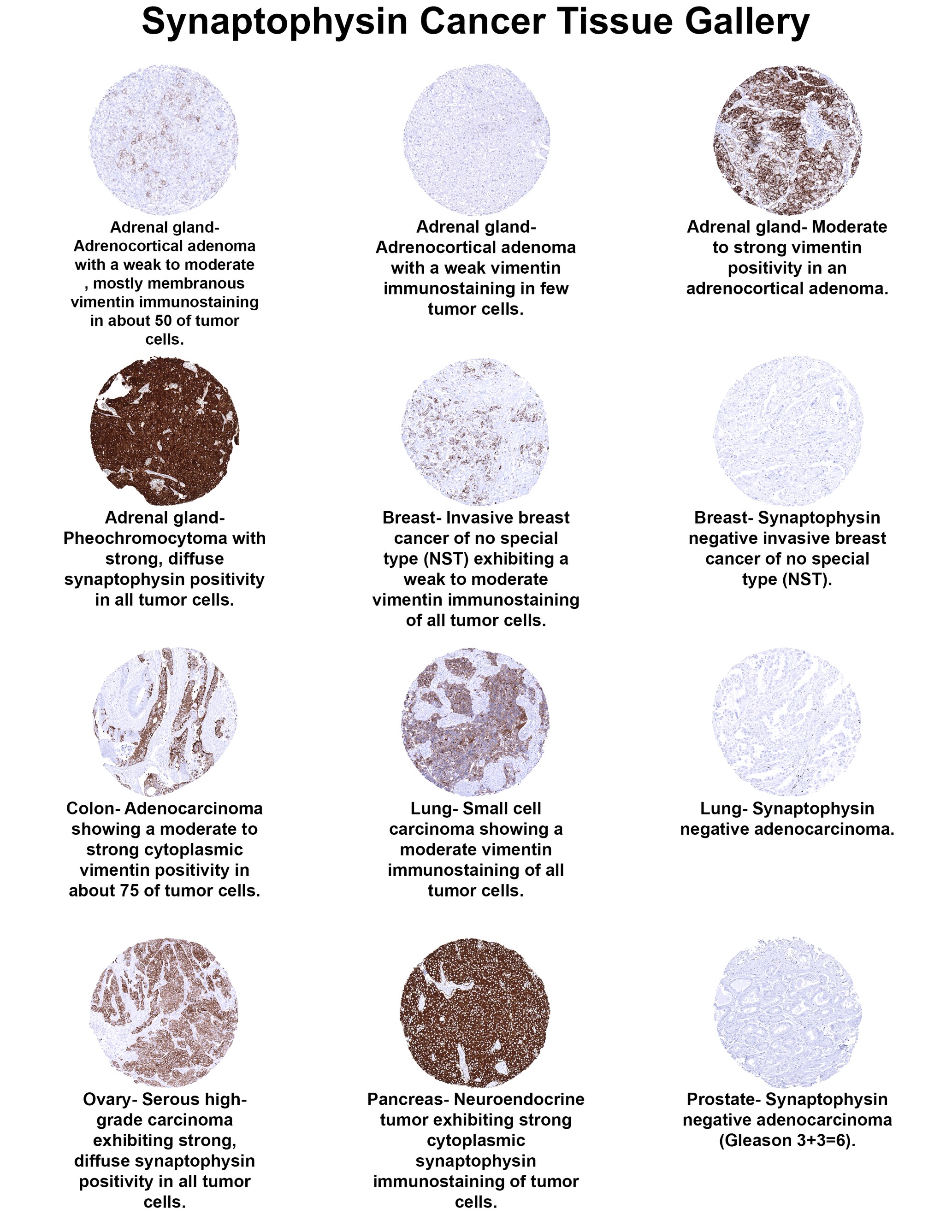 Synaptophysin Antibody (MSVA-462R) - Azide and BSA Free Synaptophysin Antibody (MSVA-462R) - Azide and BSA Free Synaptophysin Cancer Tissue Gallery