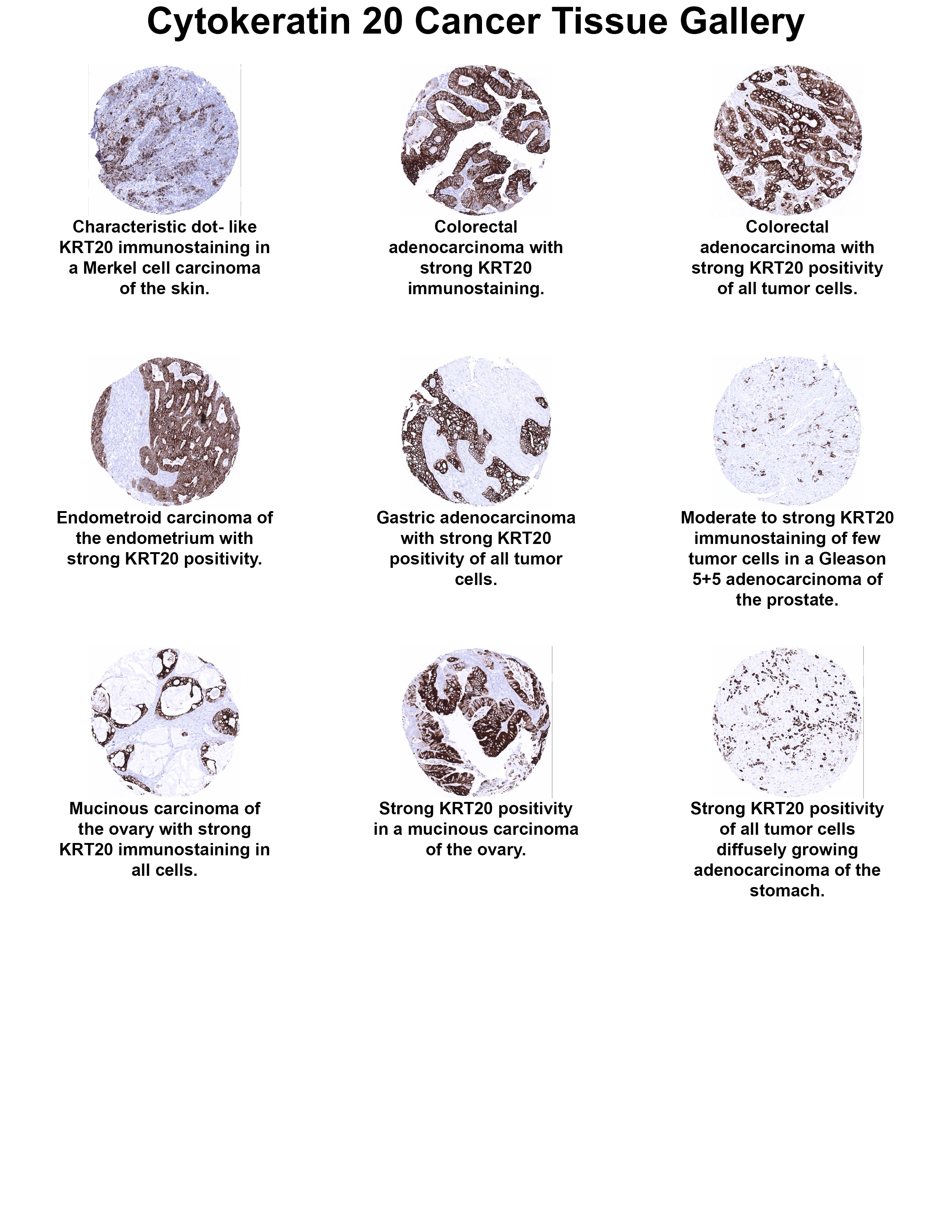 Cytokeratin 20 Antibody (MSVA-620R) - Azide and BSA Free Cytokeratin 20 Antibody (MSVA-620R) - Azide and BSA Free Cytokeratin 20 Cancer Tissue Gallery