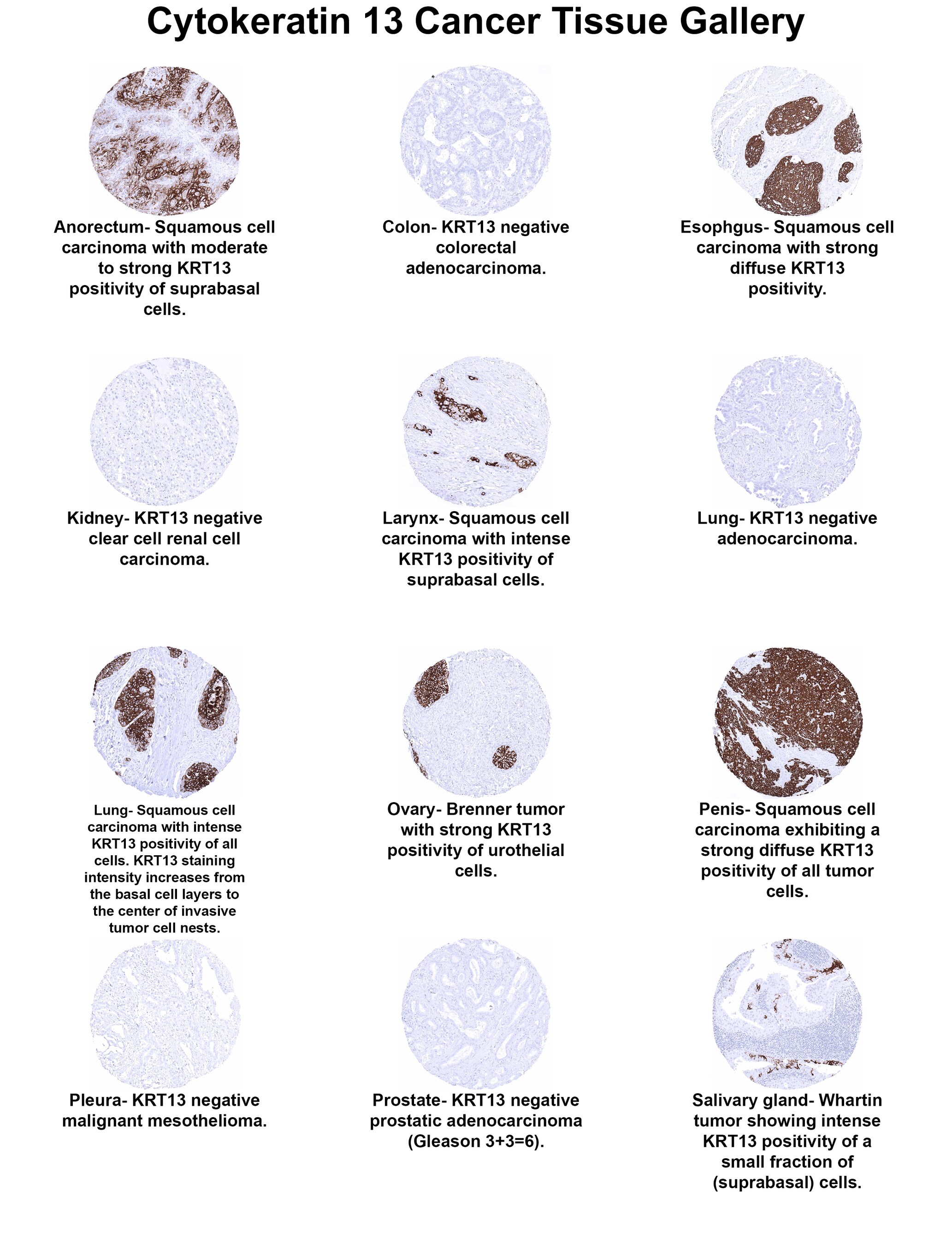 Cytokeratin 13 Antibody (MSVA-613M) - Azide and BSA Free Cytokeratin 13 Antibody (MSVA-613M) - Azide and BSA Free Cytokeratin 13 Cancer Tissue Gallery