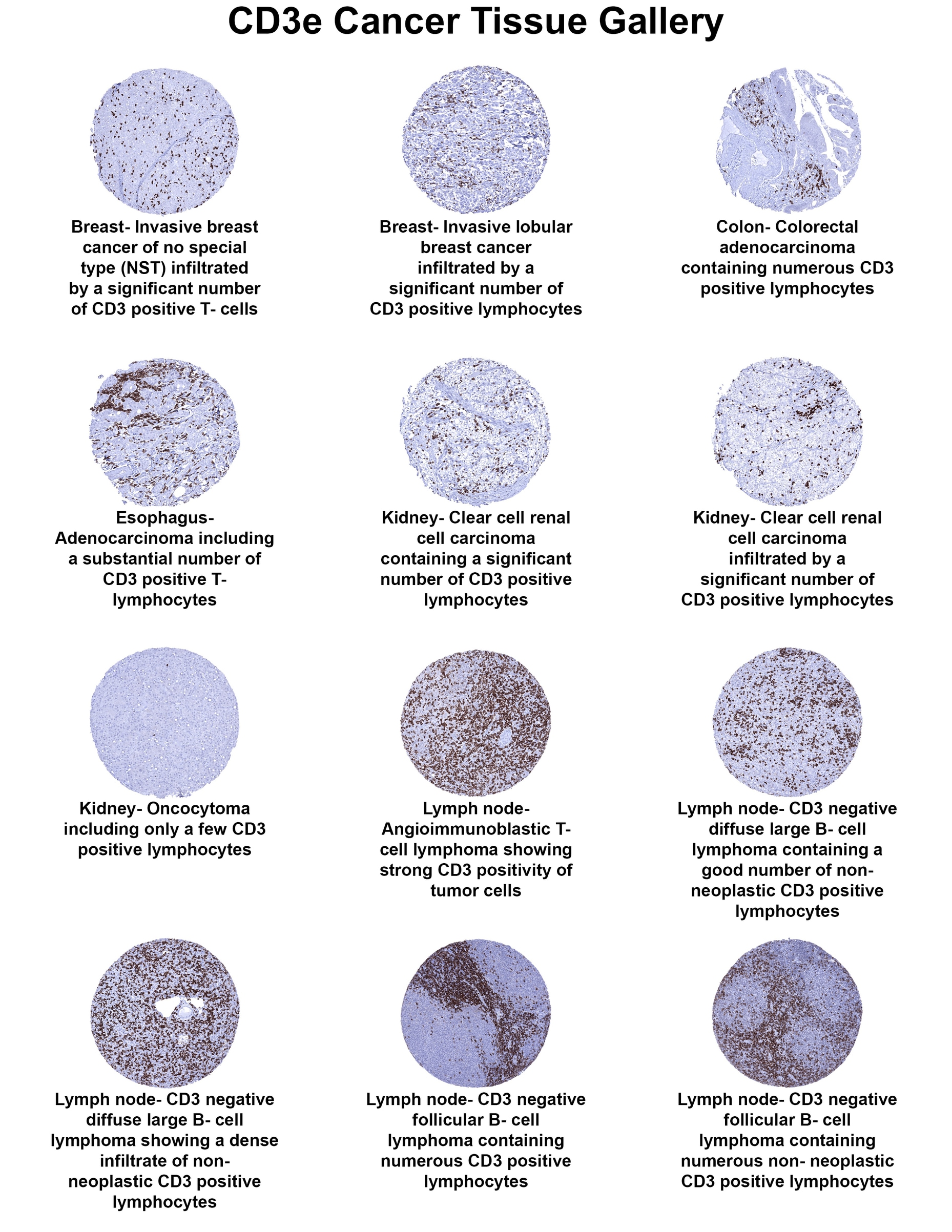CD3 Antibody (MSVA-003R) - Azide and BSA Free CD3 Antibody (MSVA-003R) - Azide and BSA Free CD3 Cancer Tissue Gallery