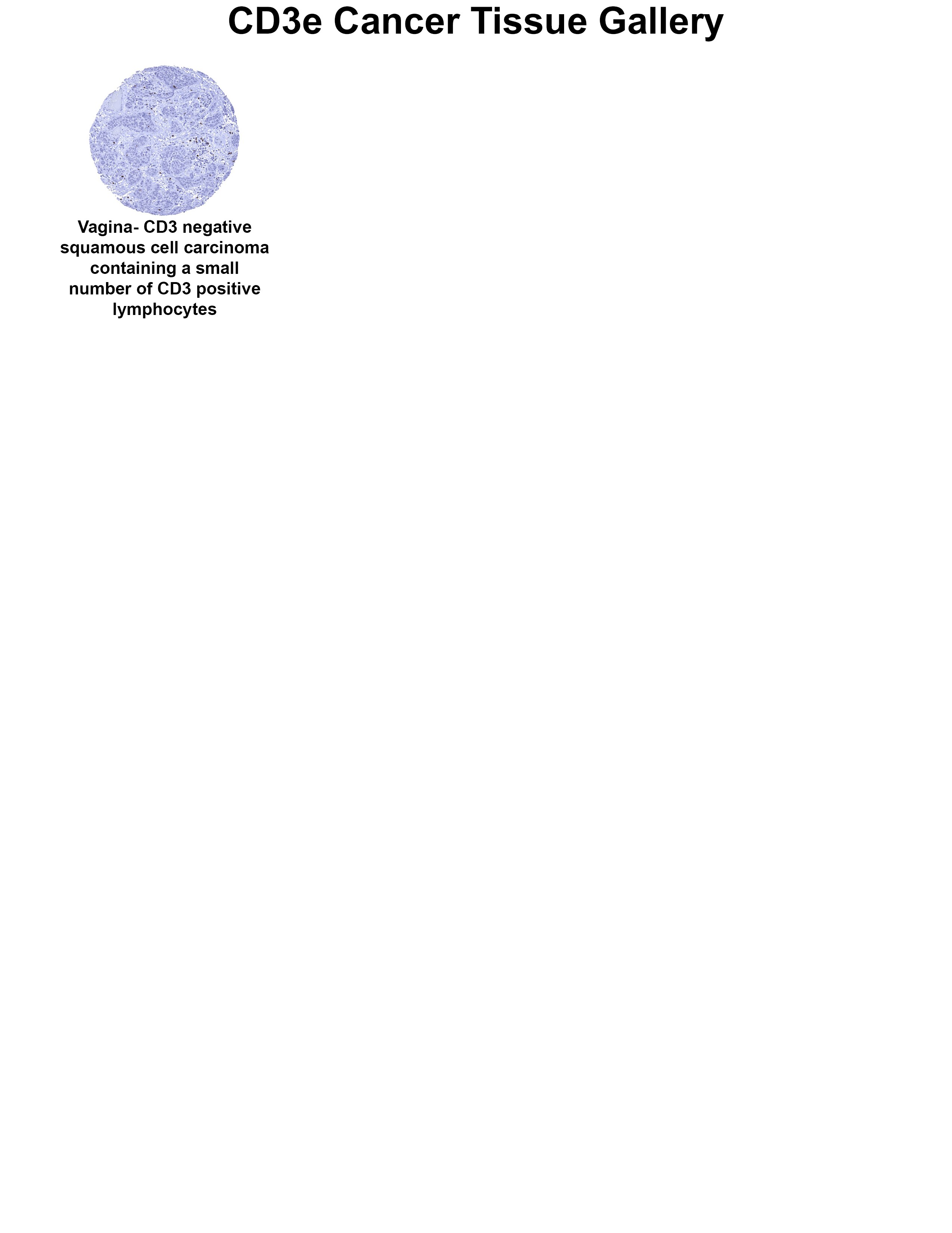 CD3 Antibody (MSVA-003R) - Azide and BSA Free CD3 Antibody (MSVA-003R) - Azide and BSA Free CD3 Cancer Tissue Gallery