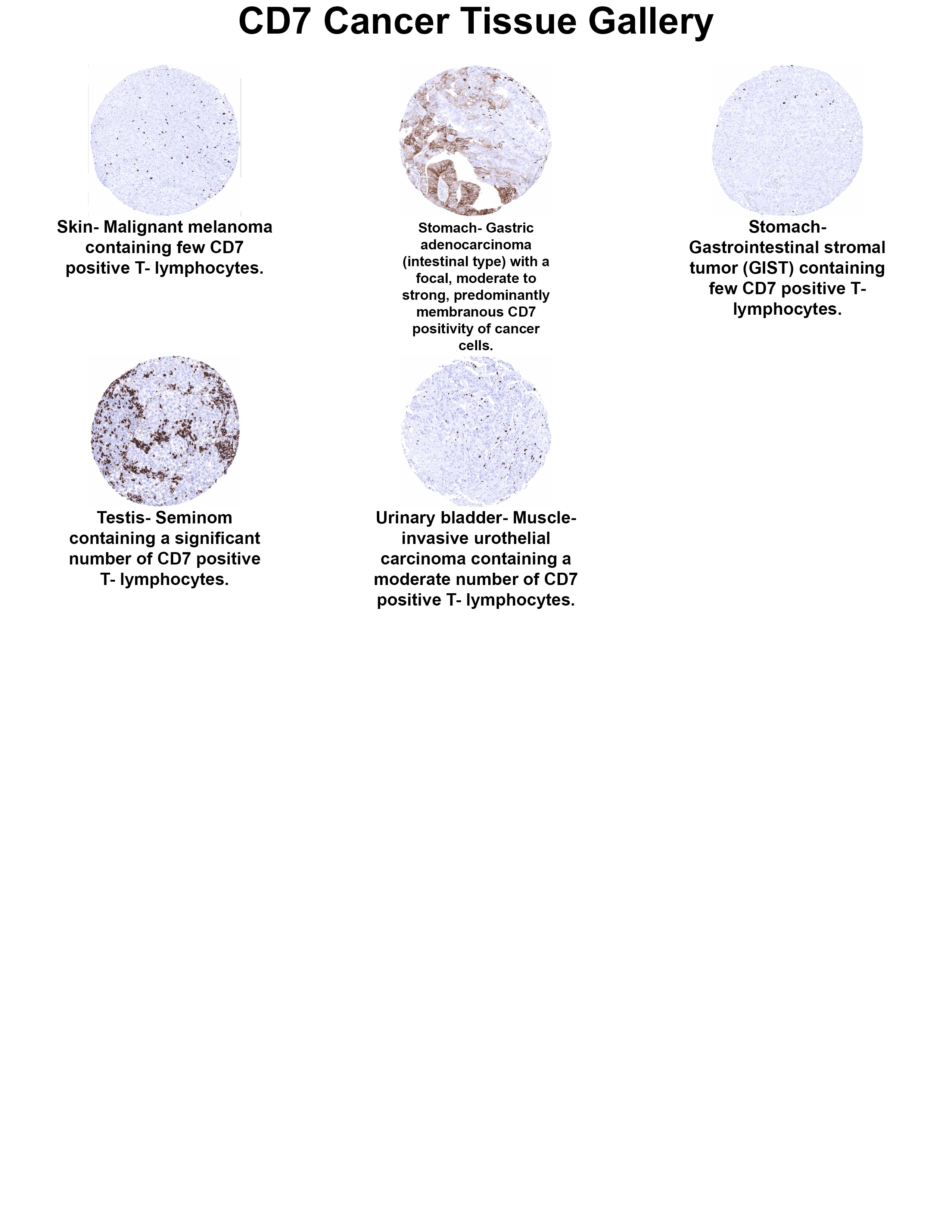 CD7 Antibody (MSVA-007R) - Azide and BSA Free CD7 Antibody (MSVA-007R) - Azide and BSA Free CD7 Cancer Tissue Gallery