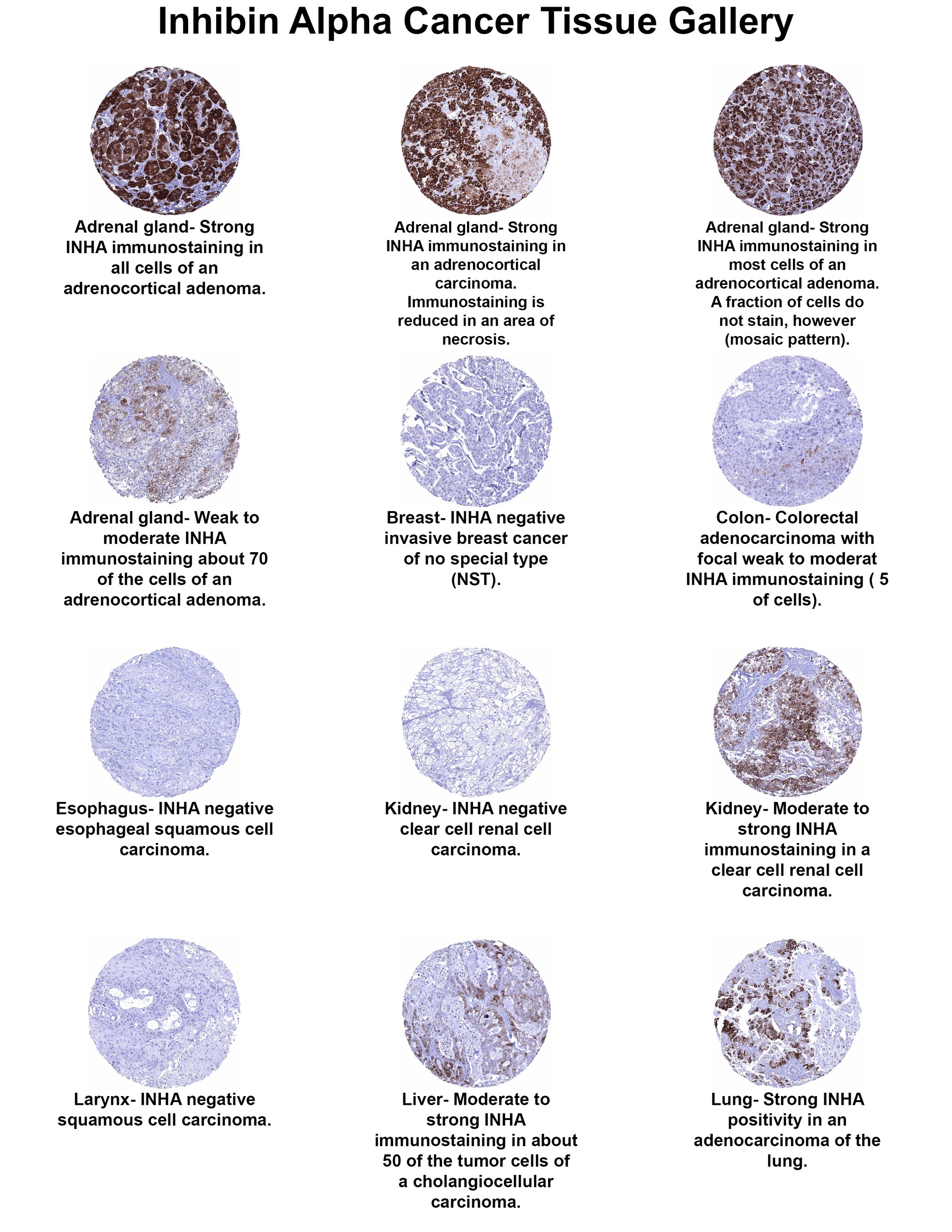 Inhibin alpha Antibody (MSVA-561R) - Azide and BSA Free Inhibin alpha Antibody (MSVA-561R) - Azide and BSA Free Inhibin alpha Cancer Tissue Gallery