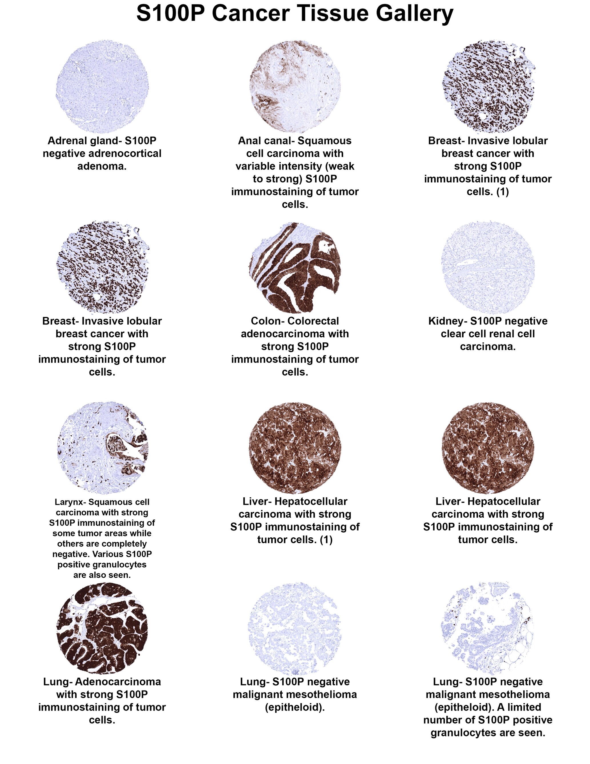 S100P Antibody (MSVA-480R) - Azide and BSA Free S100P Antibody (MSVA-480R) - Azide and BSA Free S100P Cancer Tissue Gallery