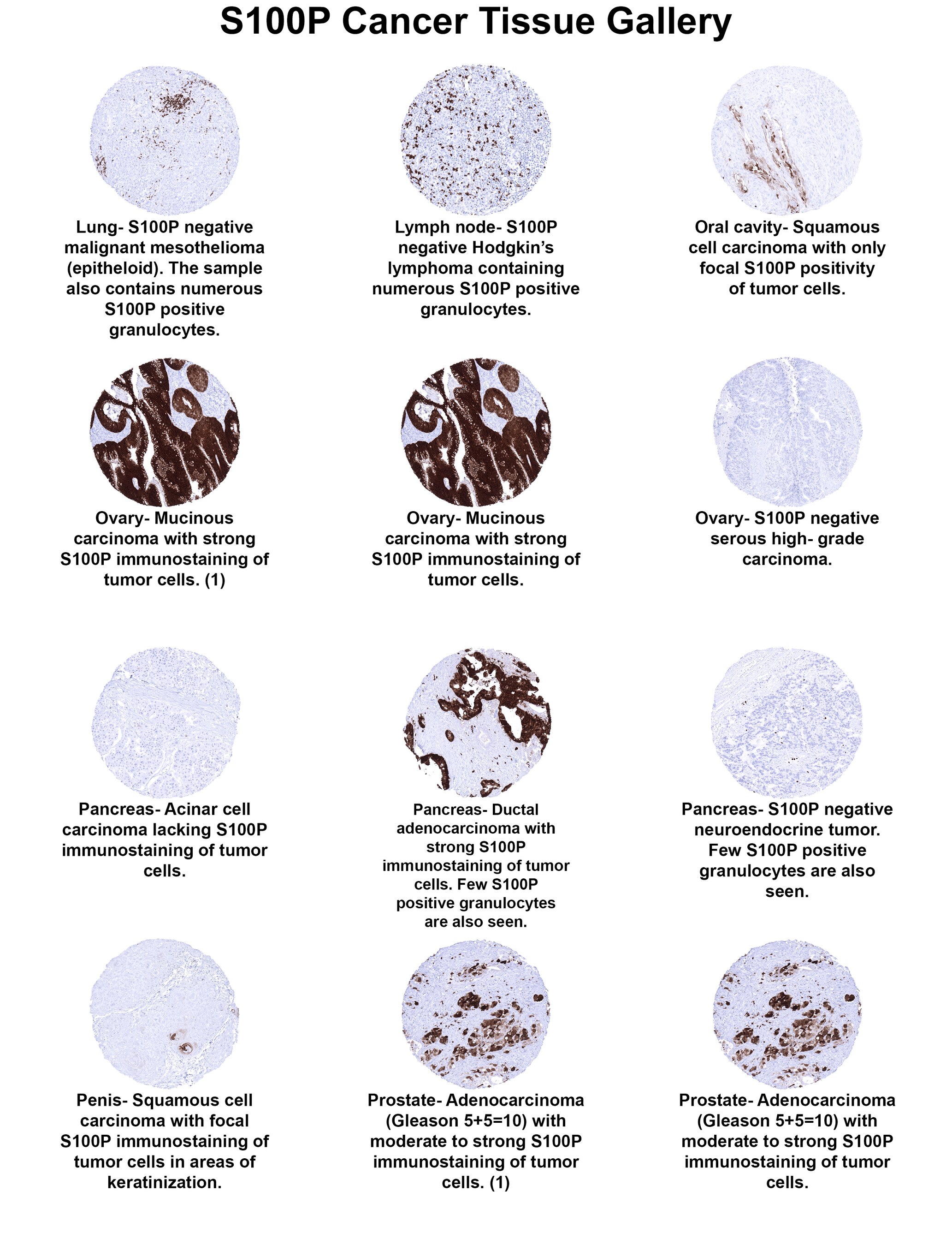 S100P Antibody (MSVA-480R) - Azide and BSA Free S100P Antibody (MSVA-480R) - Azide and BSA Free S100P Cancer Tissue Gallery