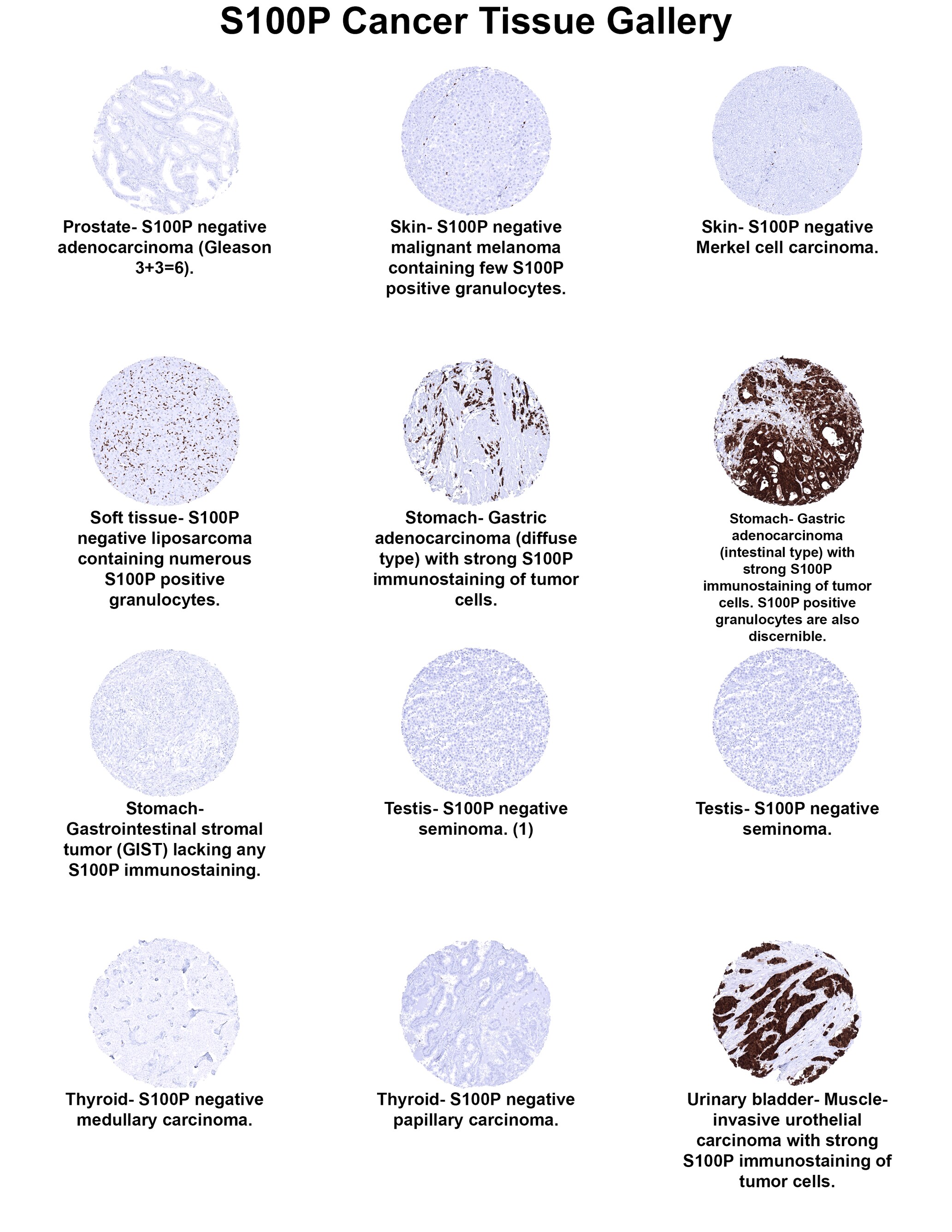 S100P Antibody (MSVA-480R) - Azide and BSA Free S100P Antibody (MSVA-480R) - Azide and BSA Free S100P Cancer Tissue Gallery