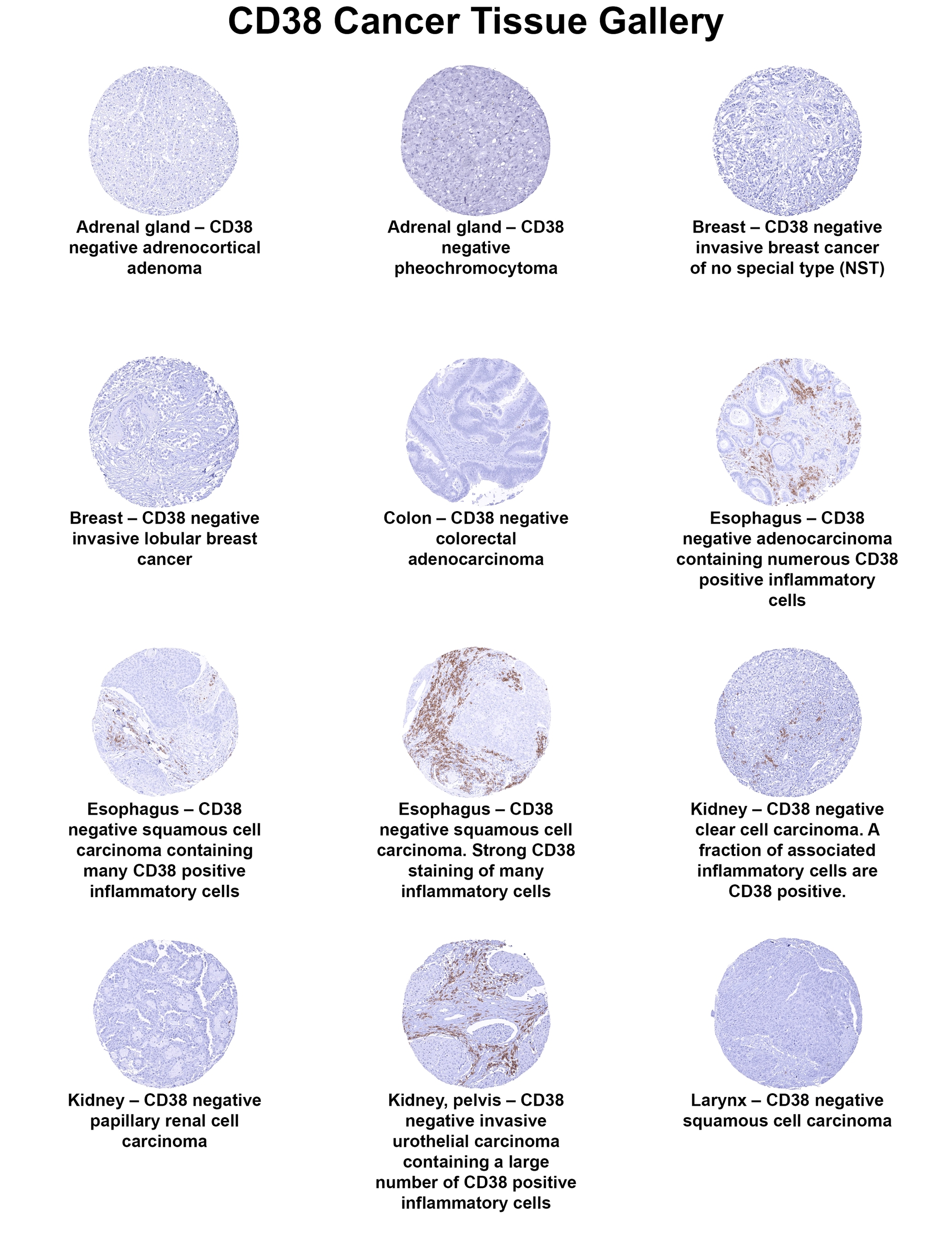 CD38 Antibody (MSVA-038R) - Azide and BSA Free CD38 Antibody (MSVA-038R) - Azide and BSA Free CD38 Cancer Tissue Gallery