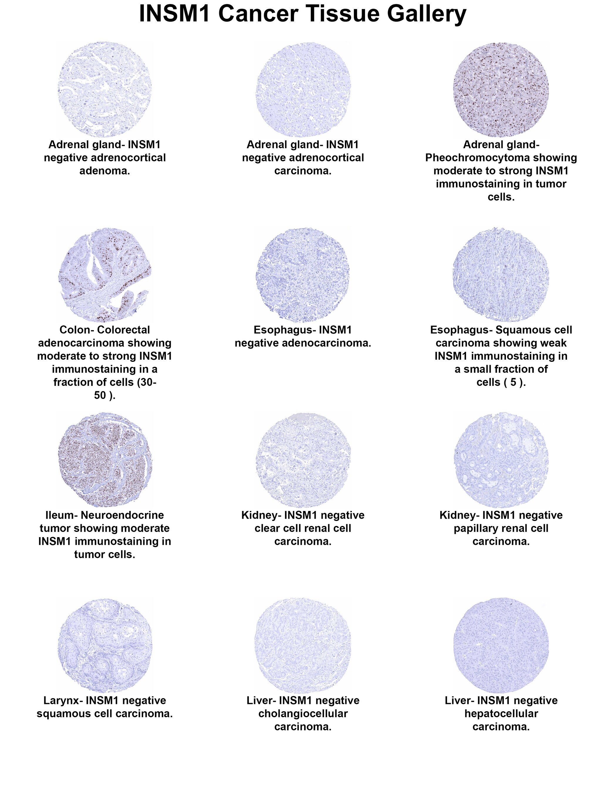 INSM1 Antibody (MSVA-456R) - Azide and BSA Free INSM1 Antibody (MSVA-456R) - Azide and BSA Free INSM1 Cancer Tissue Gallery