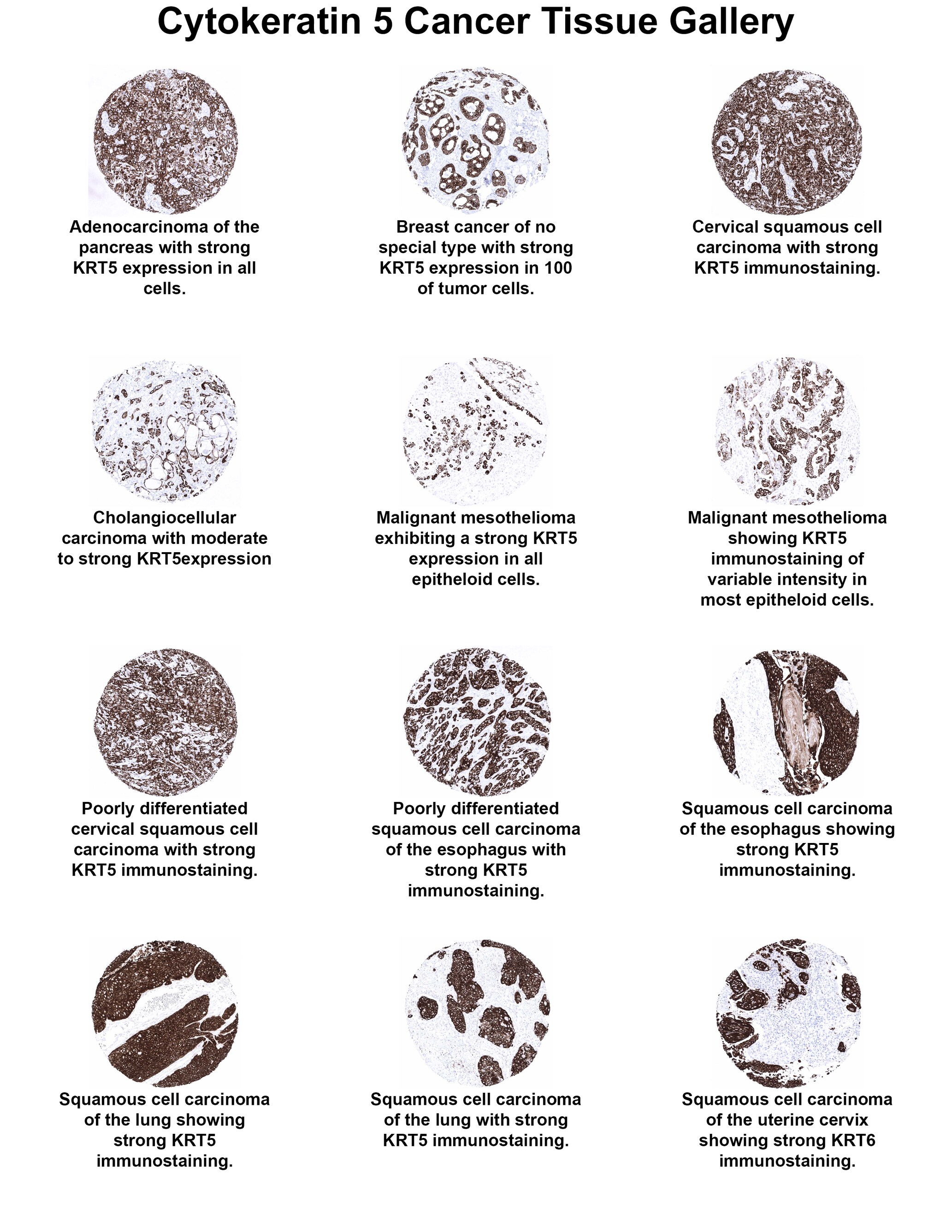Cytokeratin 5 Antibody (MSVA-605M) - Azide and BSA Free Cytokeratin 5 Antibody (MSVA-605M) - Azide and BSA Free Cytokeratin 5 Cancer Tissue Gallery