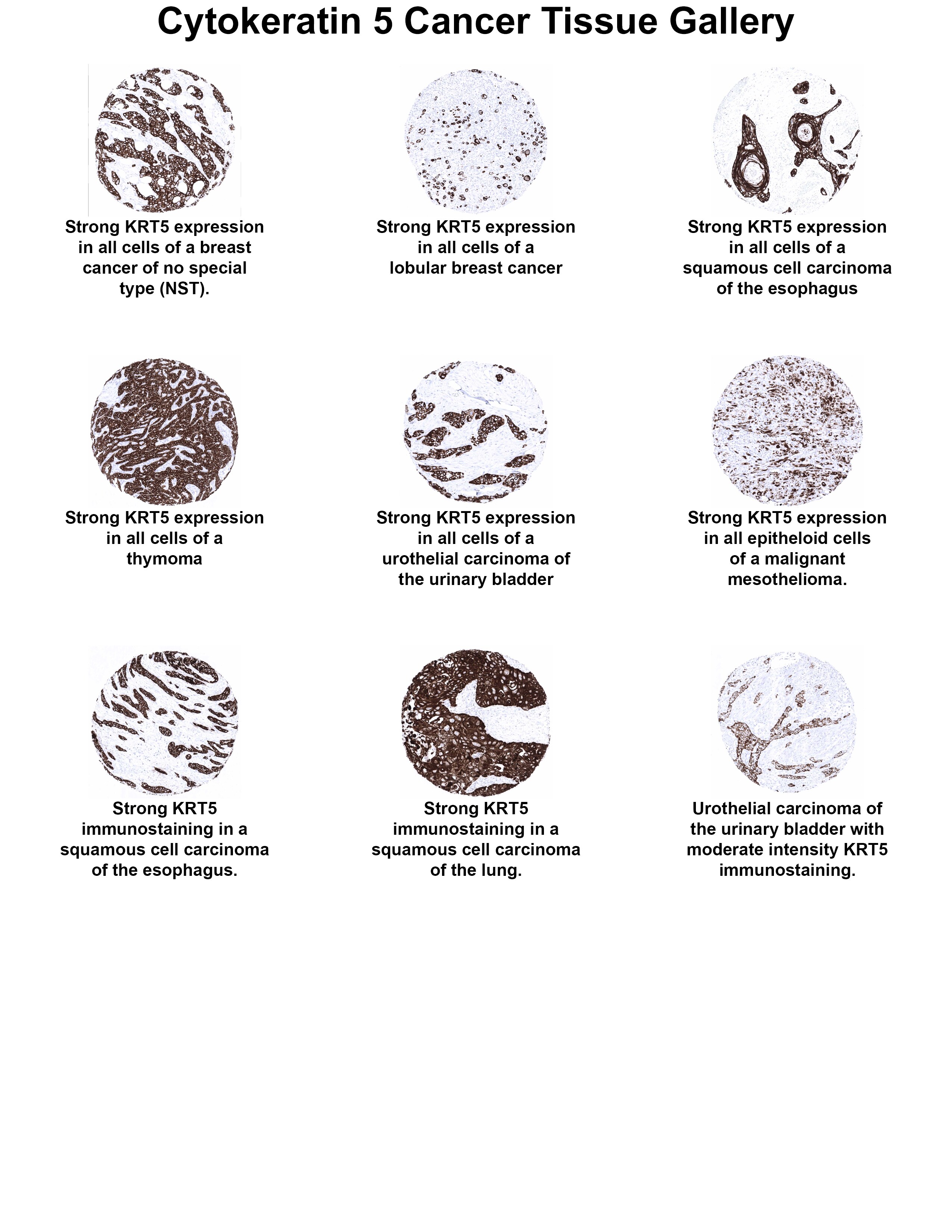 Cytokeratin 5 Antibody (MSVA-605M) - Azide and BSA Free Cytokeratin 5 Antibody (MSVA-605M) - Azide and BSA Free Cytokeratin 5 Cancer Tissue Gallery