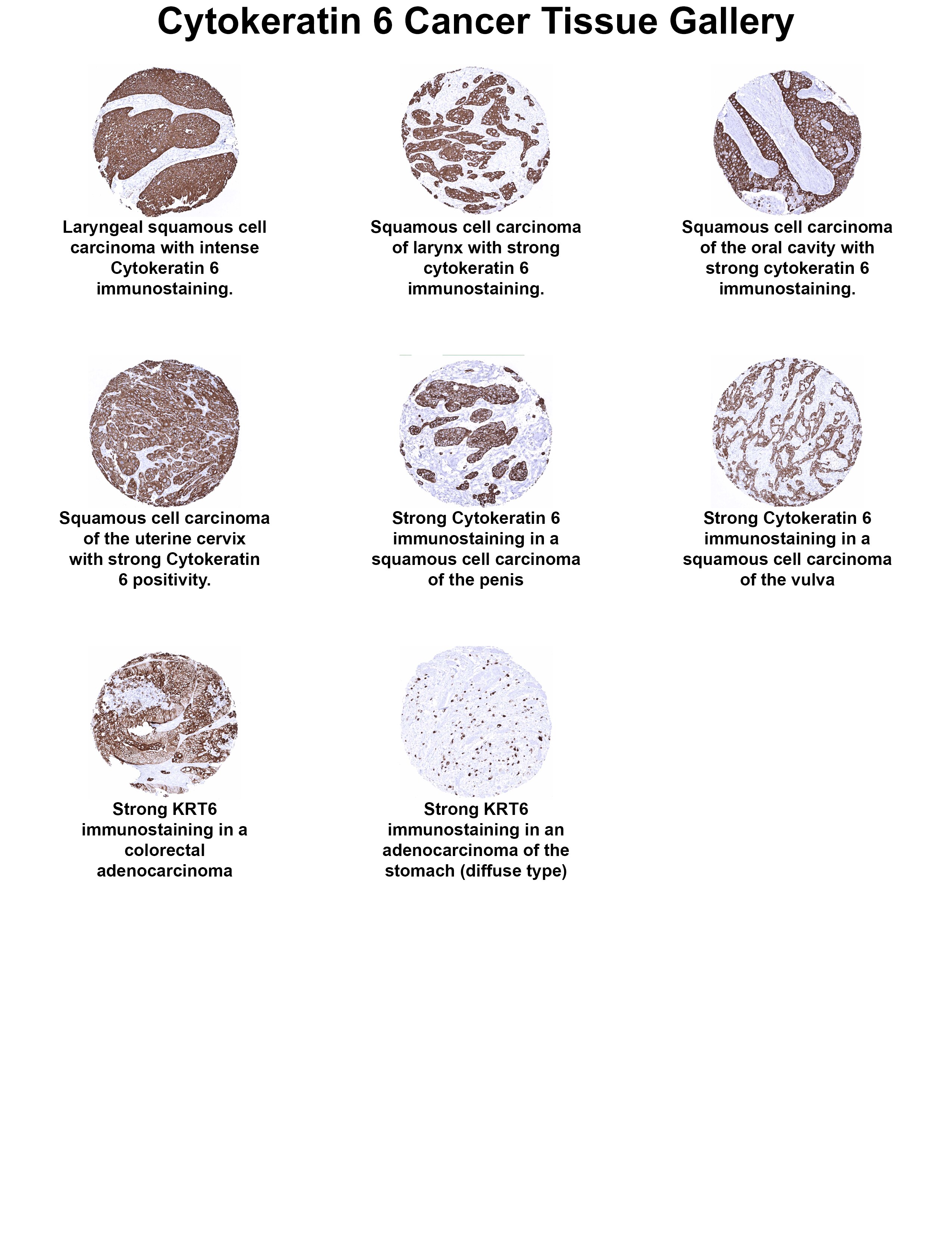 Cytokeratin 6 Antibody (MSVA-606R) - Azide and BSA Free Cytokeratin 6 Antibody (MSVA-606R) - Azide and BSA Free Cytokeratin 6 Cancer Tissue Gallery