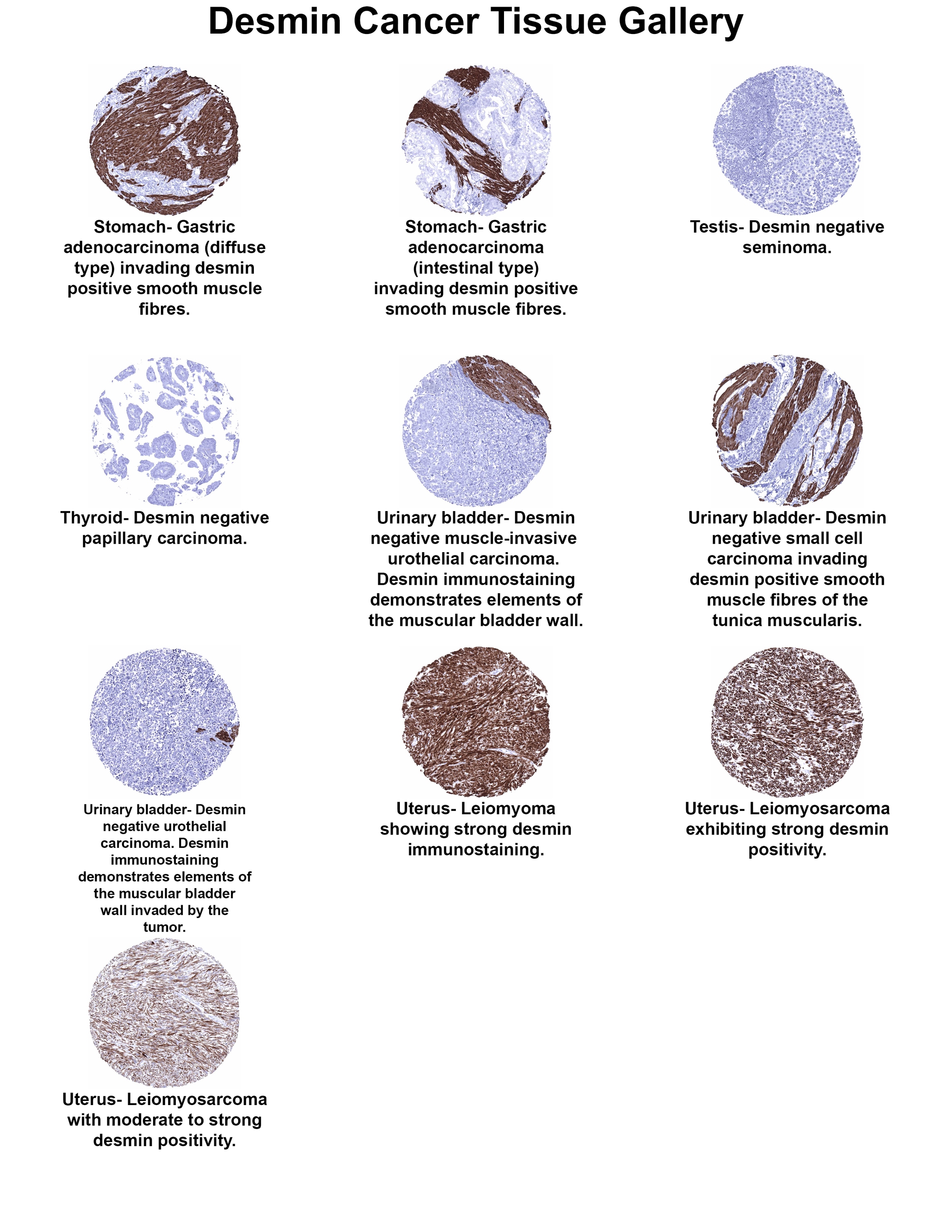 Desmin Antibody (MSVA-651M) - Azide and BSA Free Desmin Antibody (MSVA-651M) - Azide and BSA Free Desmin Cancer Tissue Gallery