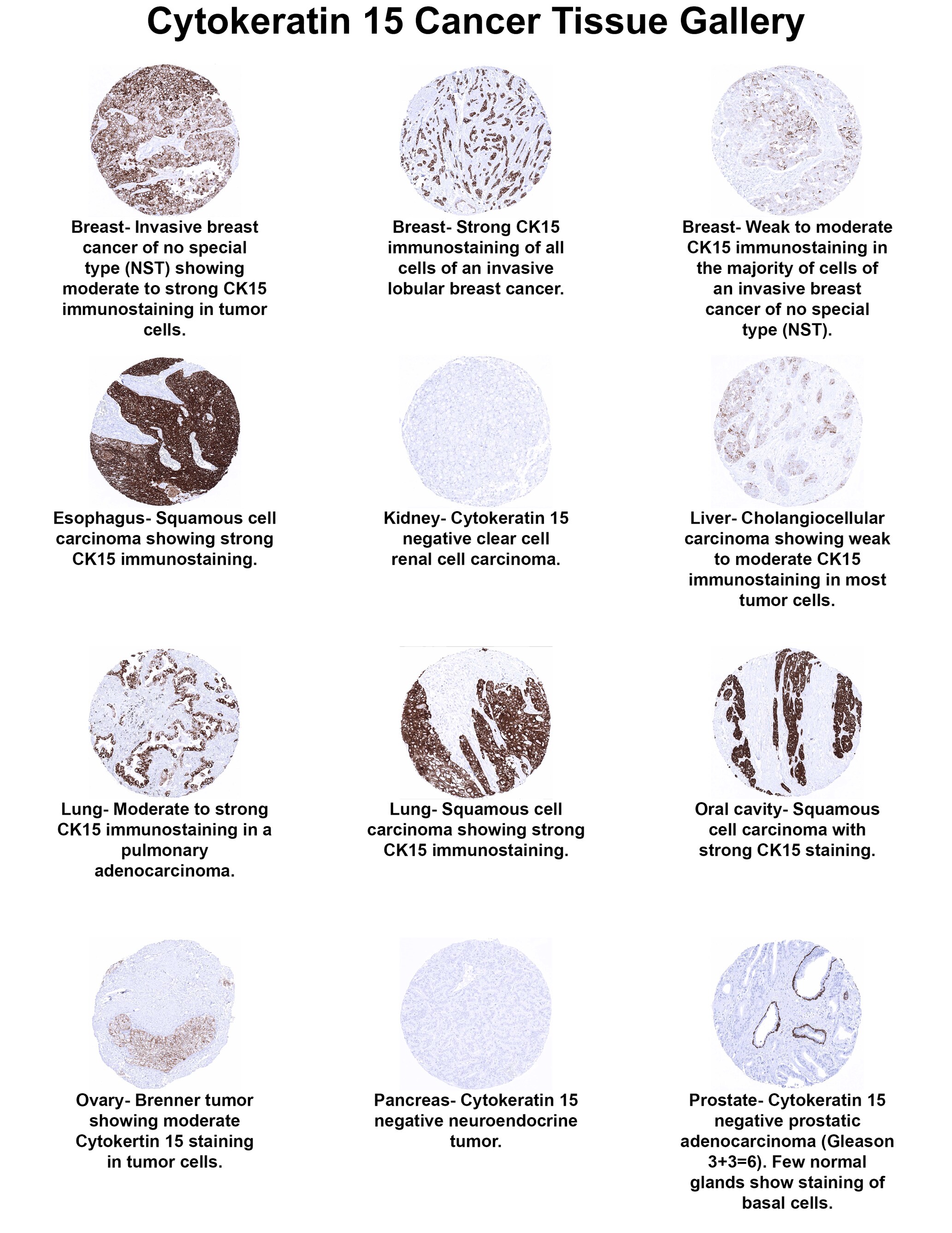Cytokeratin 15 Antibody (MSVA-615M) - Azide and BSA Free Cytokeratin 15 Antibody (MSVA-615M) - Azide and BSA Free Cytokeratin 15 Cancer Tissue Gallery