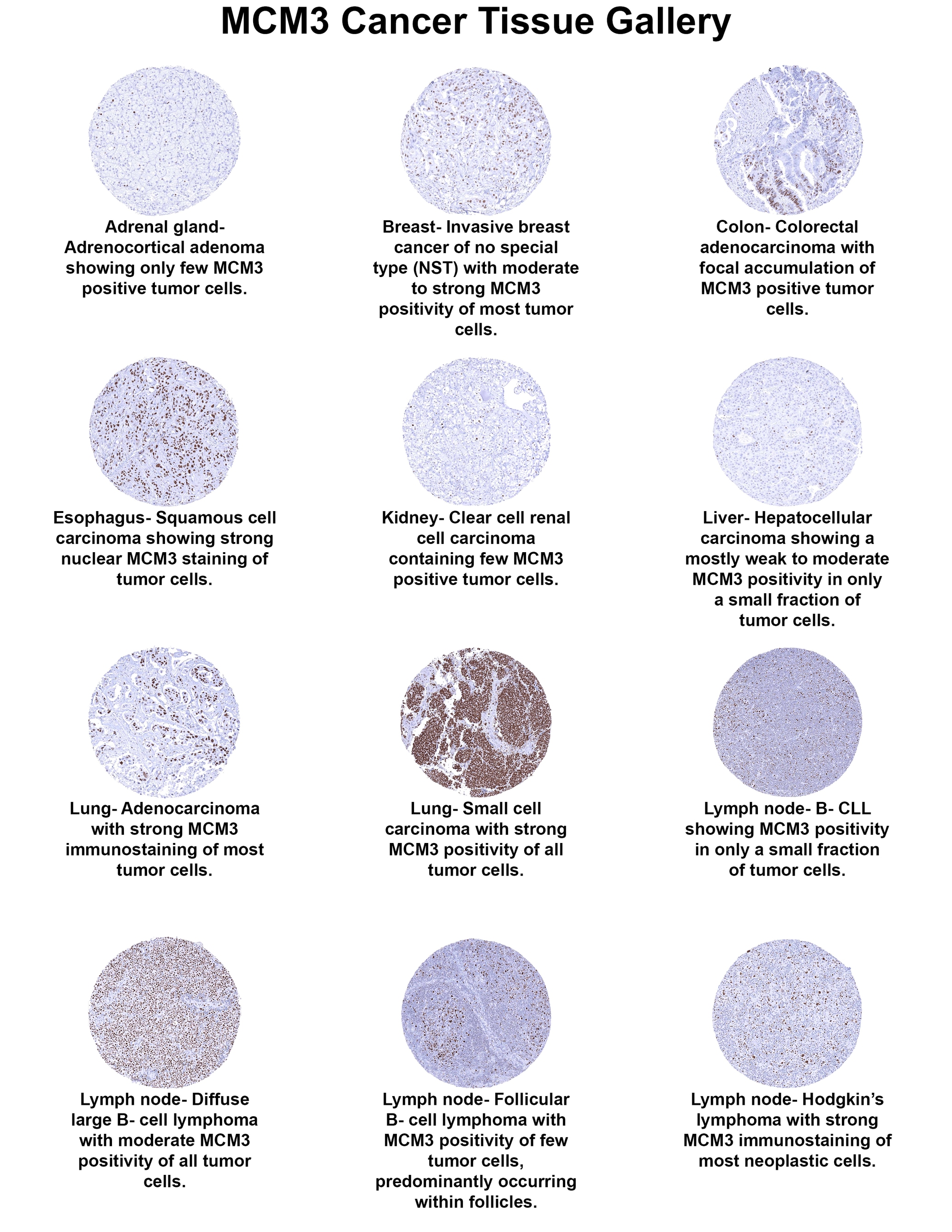 MCM3 Antibody (MSVA-503M) - Azide and BSA Free MCM3 Antibody (MSVA-503M) - Azide and BSA Free MCM3 Cancer Tissue Gallery