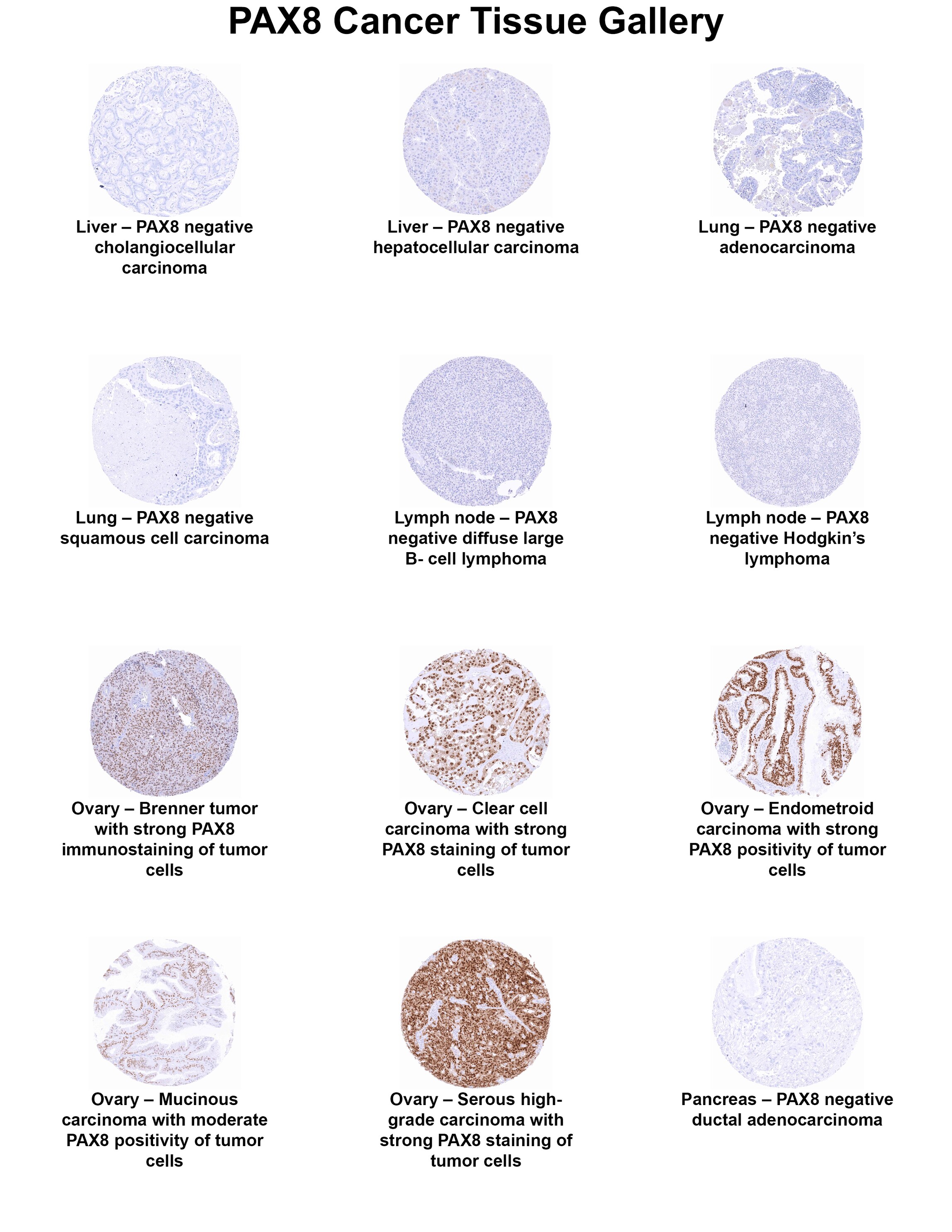 PAX8 Antibody (MSVA-708R) - Azide and BSA Free PAX8 Antibody (MSVA-708R) - Azide and BSA Free PAX8 Cancer Tissue Gallery