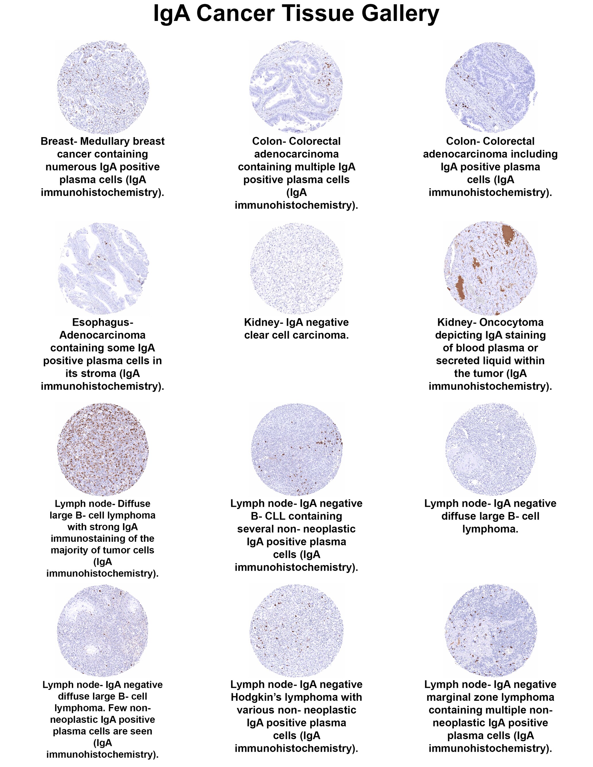 IgA Antibody (MSVA-700R) - Azide and BSA Free IgA Antibody (MSVA-700R) - Azide and BSA Free IgA Cancer Tissue Gallery