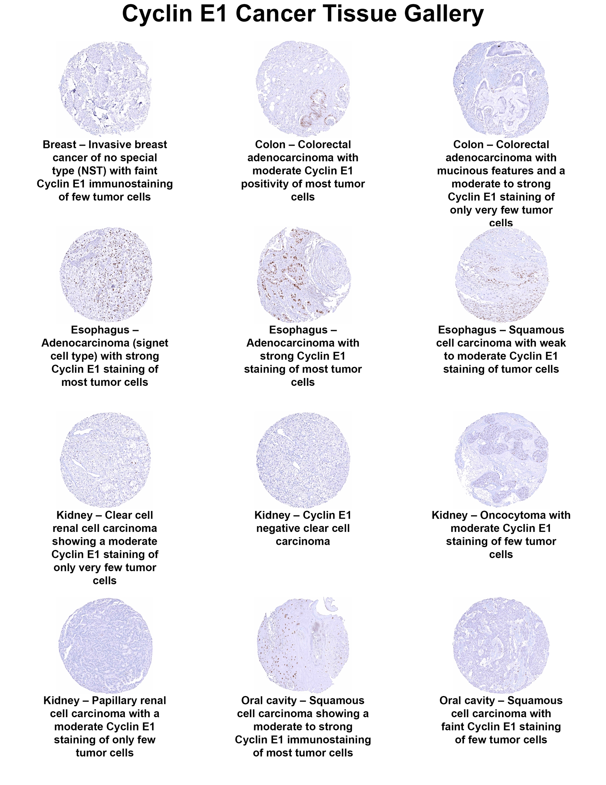 Cyclin E1 Antibody (MSVA-898R) - Azide and BSA Free Cyclin E1 Antibody (MSVA-898R) - Azide and BSA Free Cyclin E1 Cancer Tissue Gallery