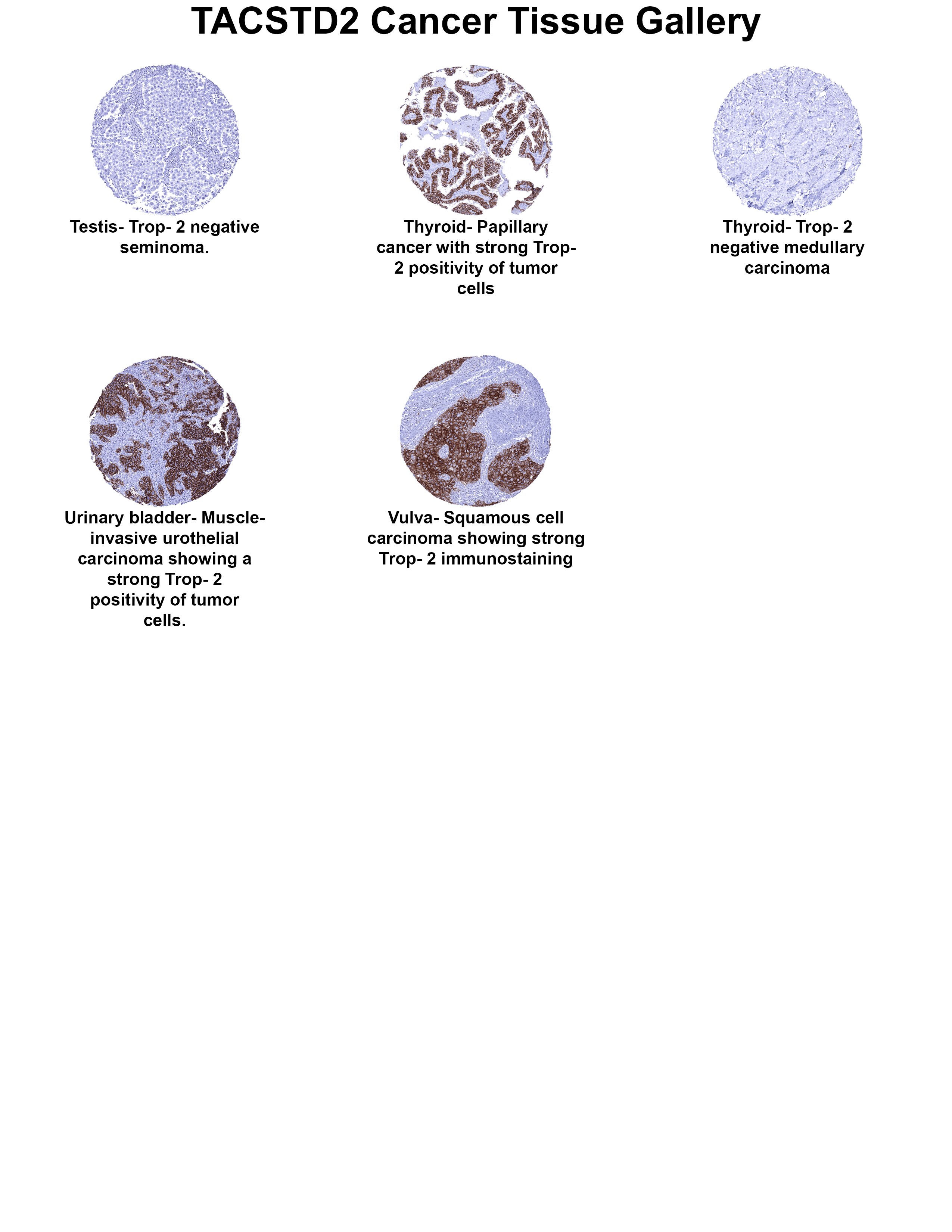 TROP-2 Antibody (MSVA-733R) - Azide and BSA Free TROP-2 Antibody (MSVA-733R) - Azide and BSA Free TROP-2 Cancer Tissue Gallery