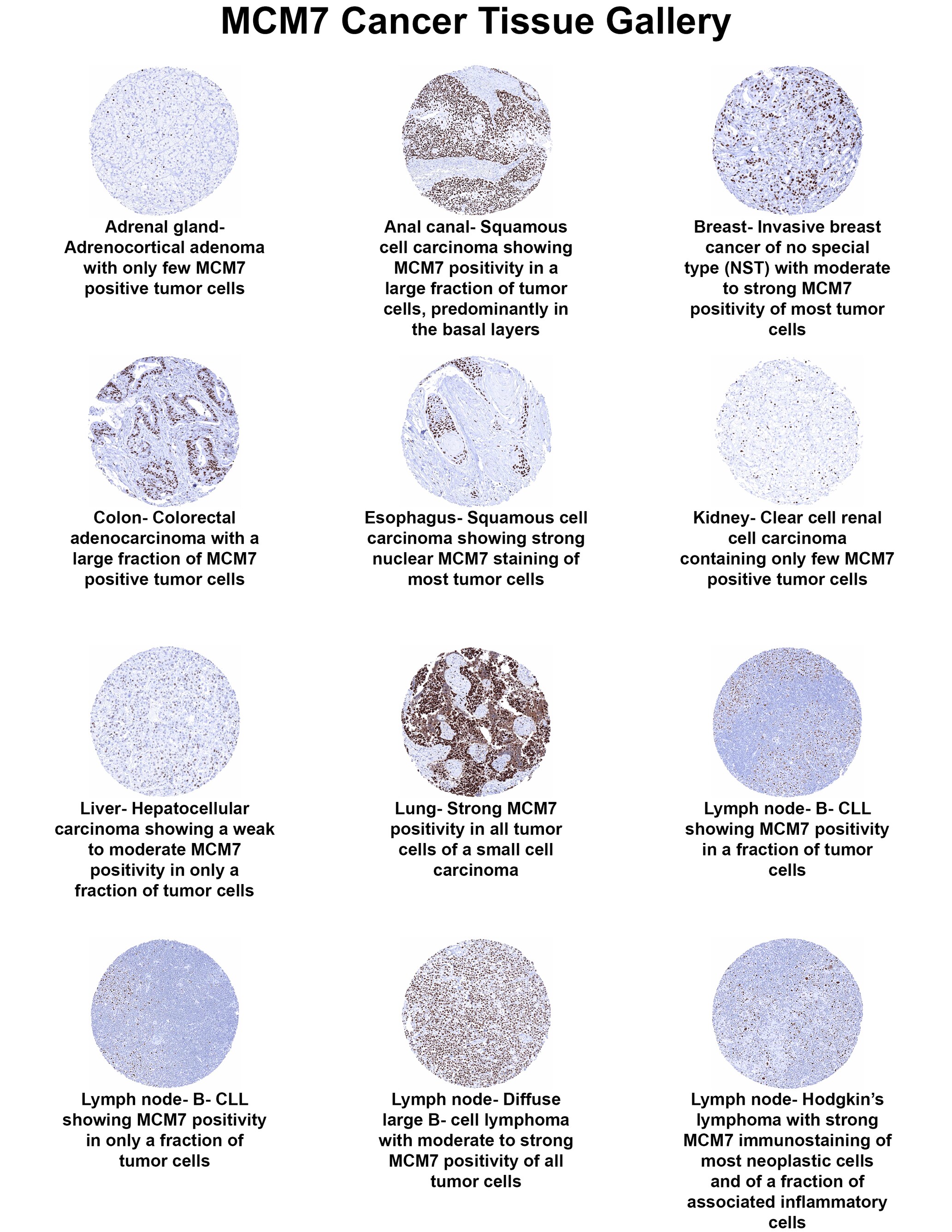 MCM7 Antibody (MSVA-507R) - Azide and BSA Free MCM7 Antibody (MSVA-507R) - Azide and BSA Free MCM7 Cancer Tissue Gallery