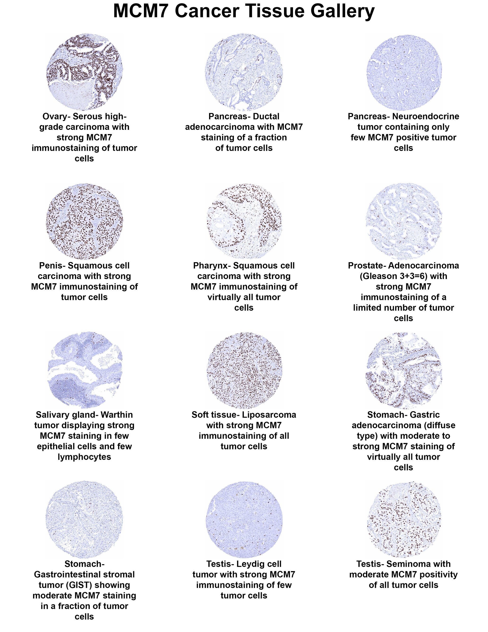 MCM7 Antibody (MSVA-507R) - Azide and BSA Free MCM7 Antibody (MSVA-507R) - Azide and BSA Free MCM7 Cancer Tissue Gallery